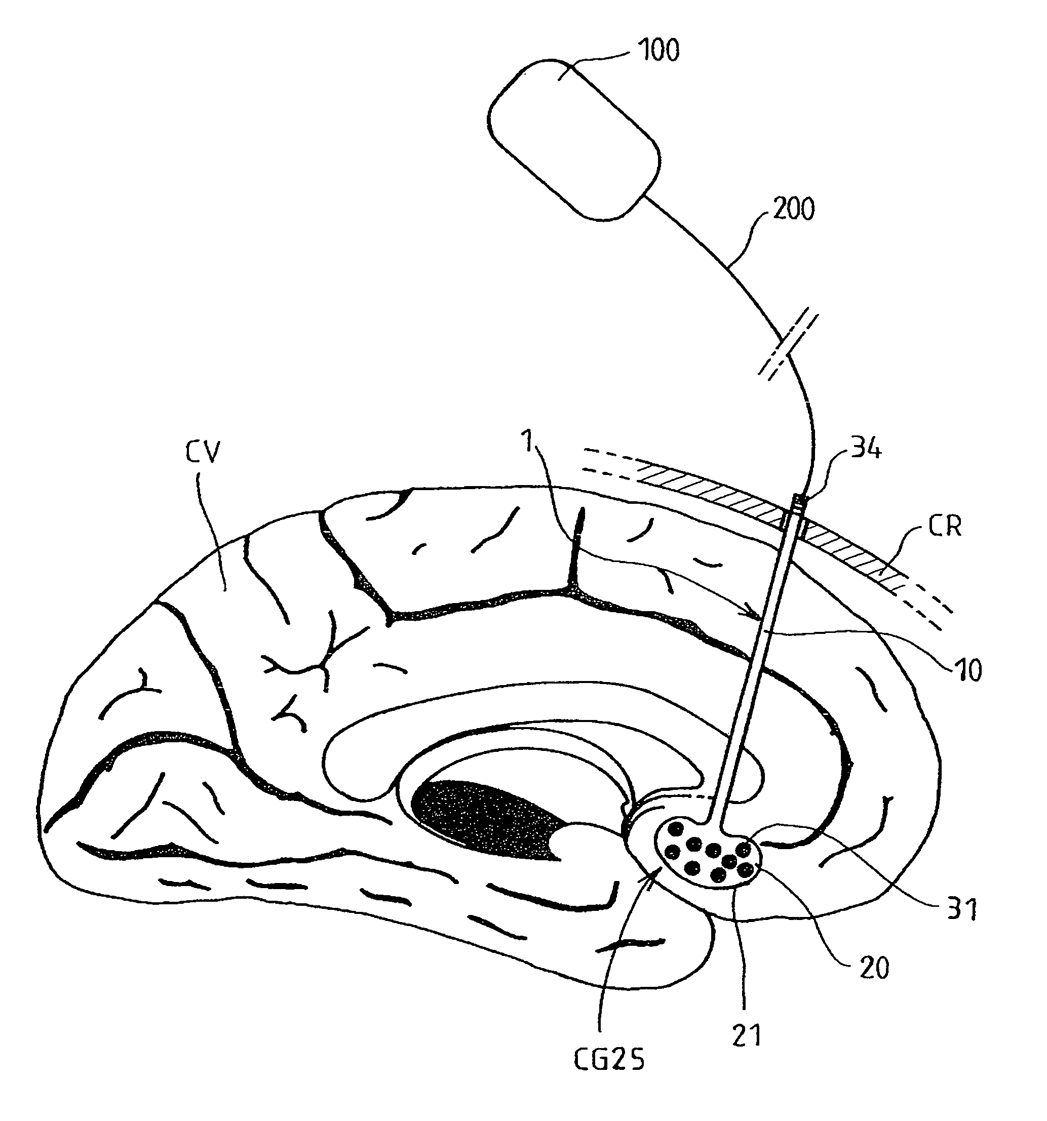 Multiple electrode lead and a system for deep electrical neurostimulation including such a lead