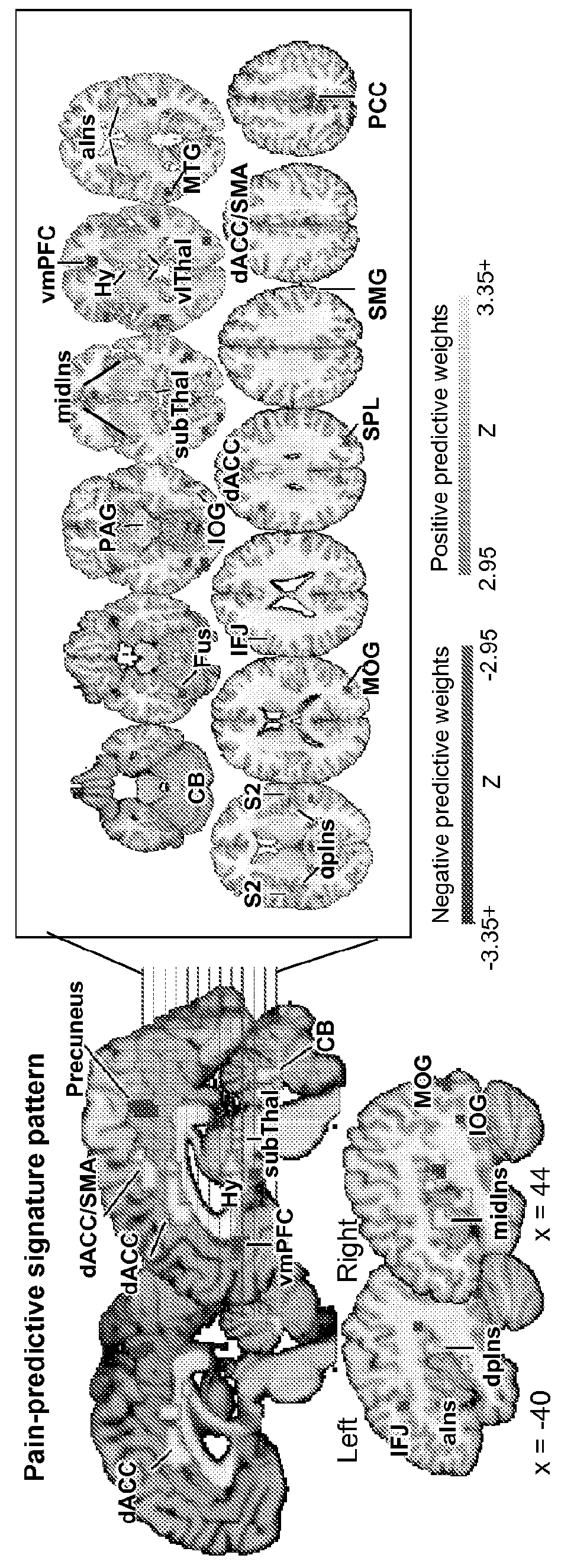 Fmri-based neurologic signature of physical pain