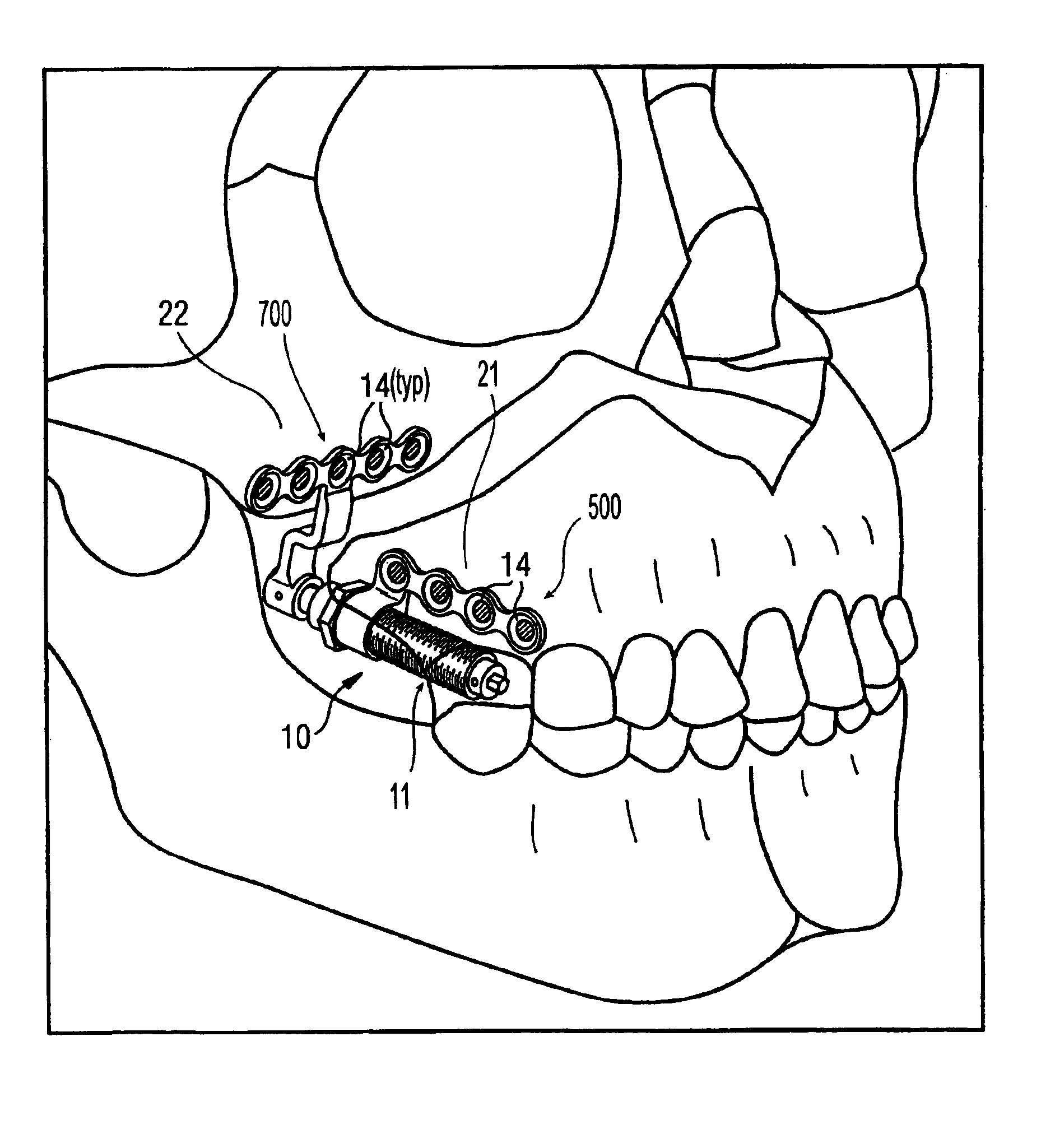 Compact maxillary distractor