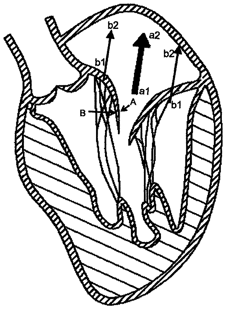 A heart valve prosthesis with clamping device