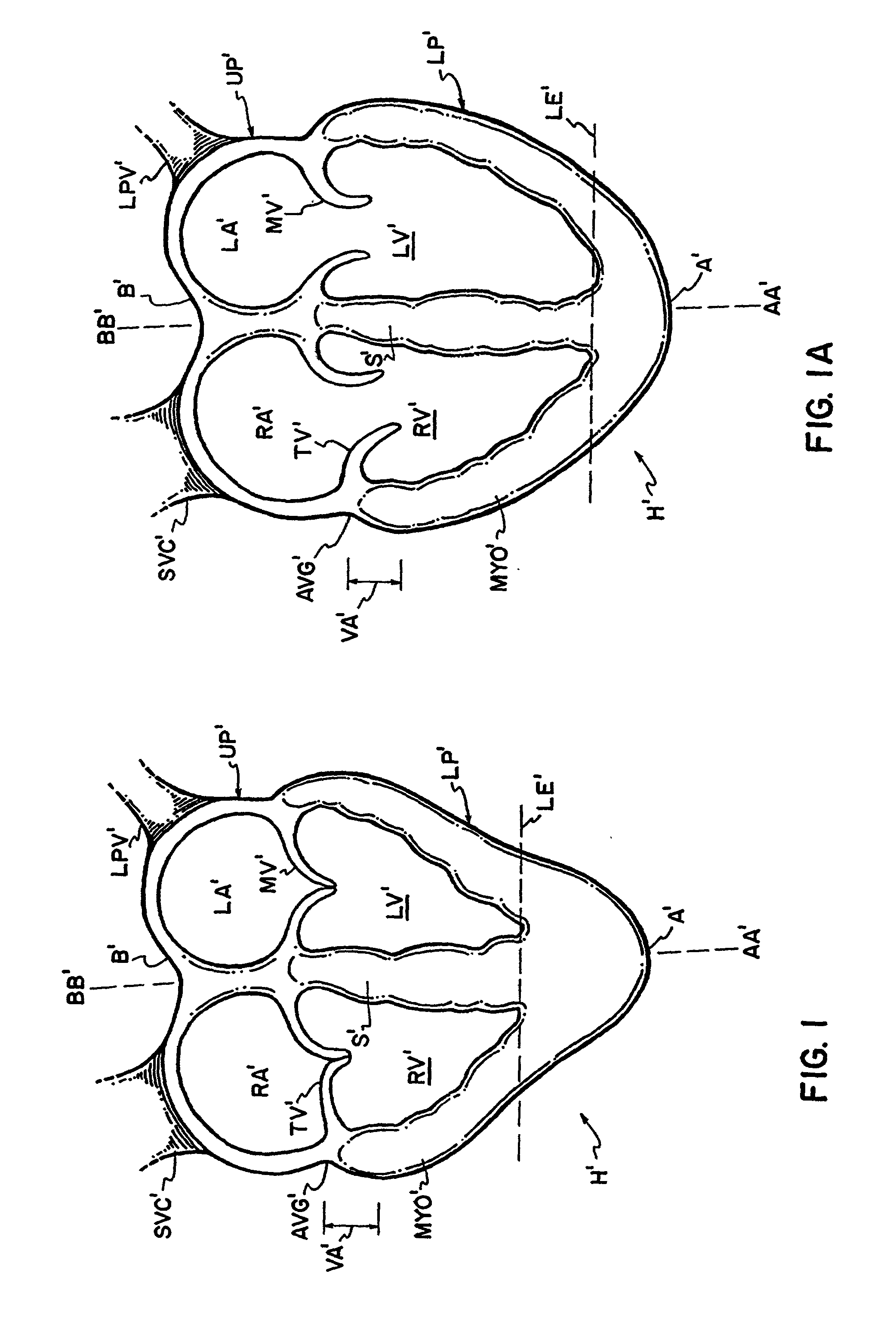 Tension indicator for cardiac support device and method therefore