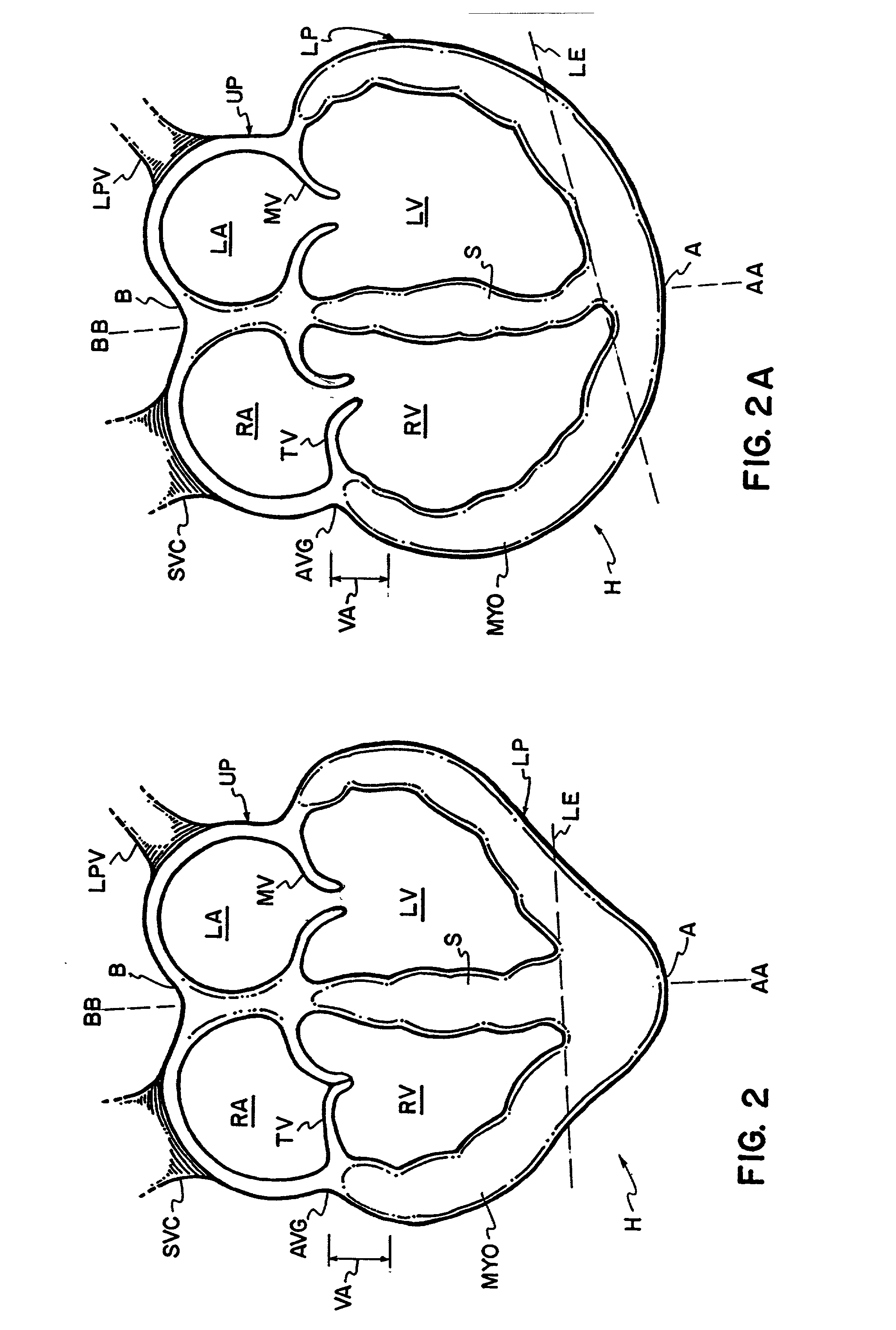 Tension indicator for cardiac support device and method therefore