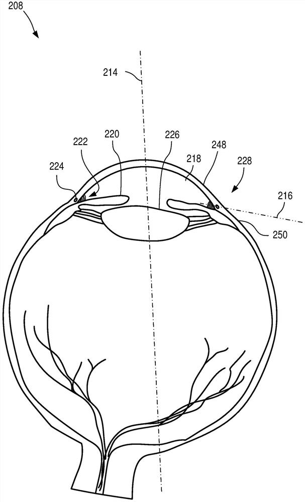 Paralimbal laser probe