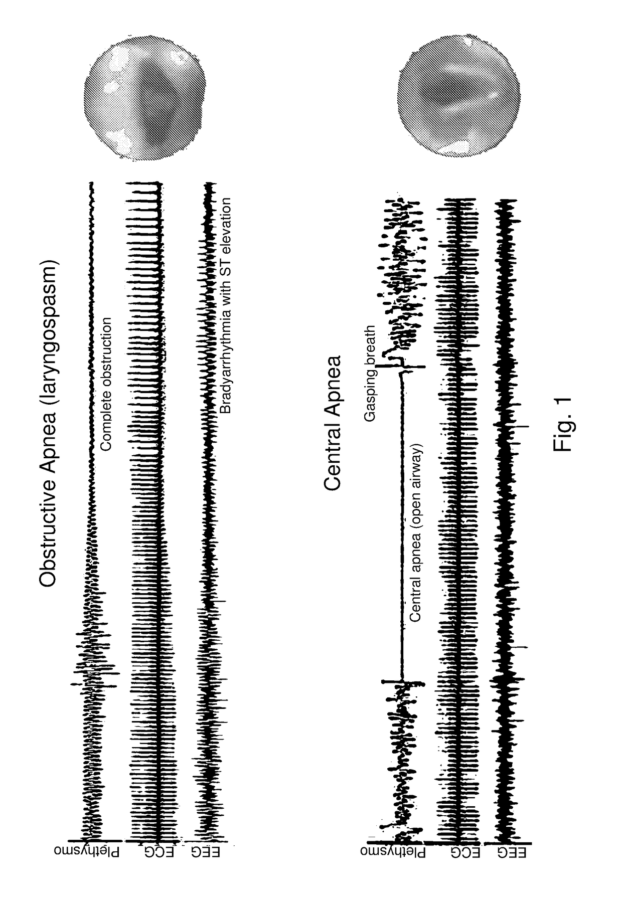 Acute pulmonary pressurization device and method of use