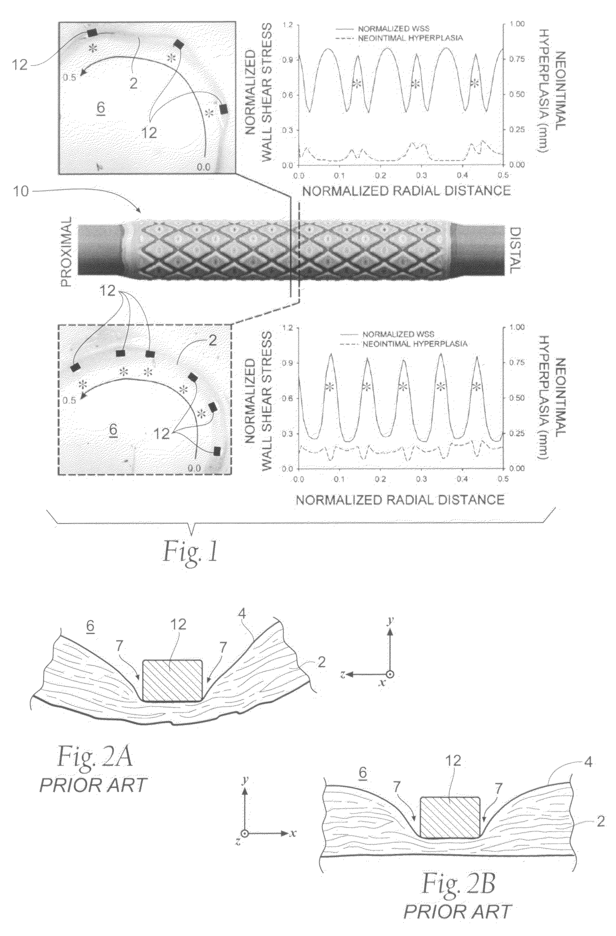 Apparatus and method for minimizing flow disturbances in a stented region of a lumen