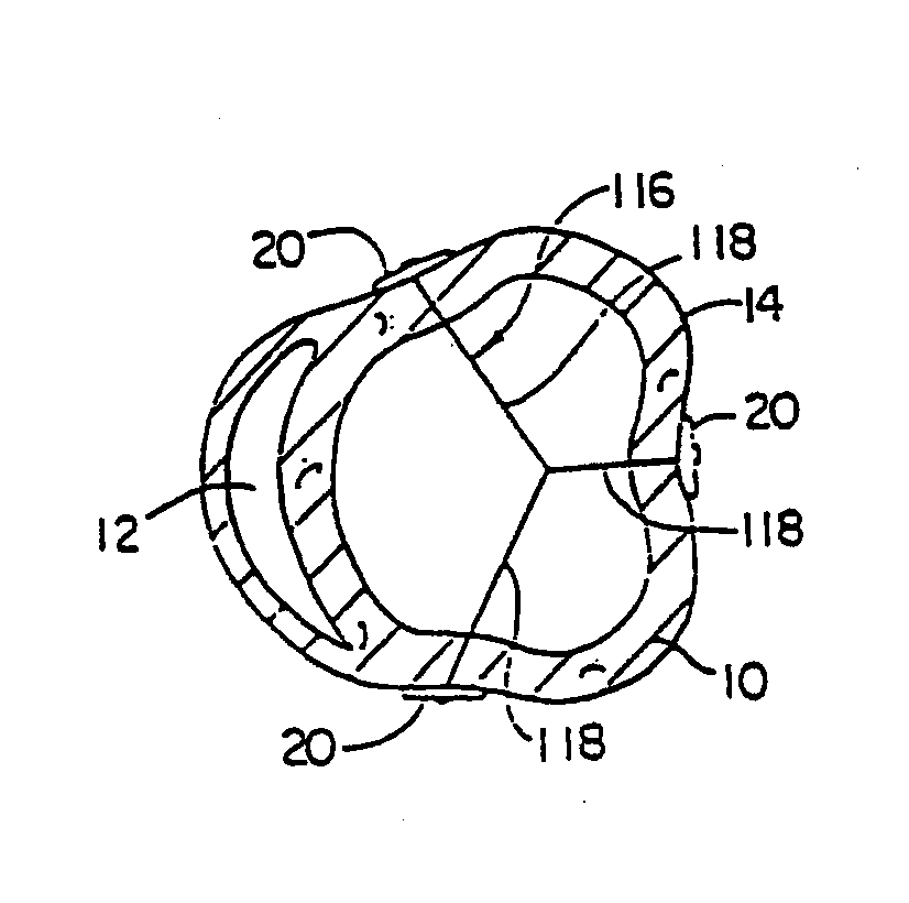 Heart wall tension reduction apparatus