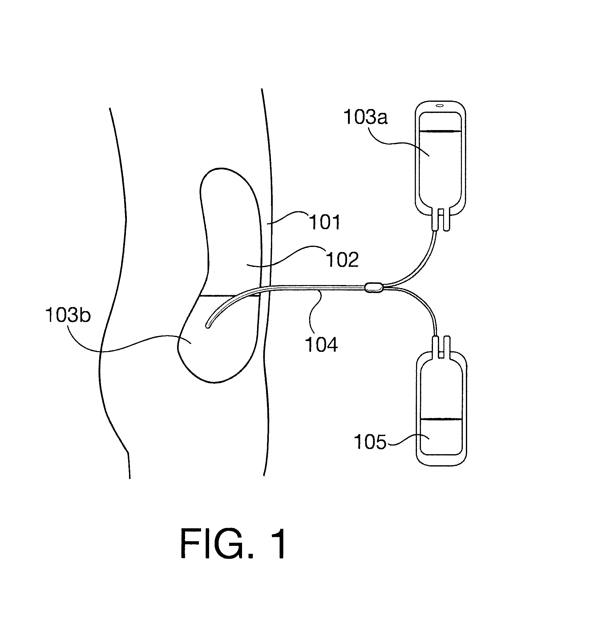 System and Method for Administering Peritoneal Dialysis