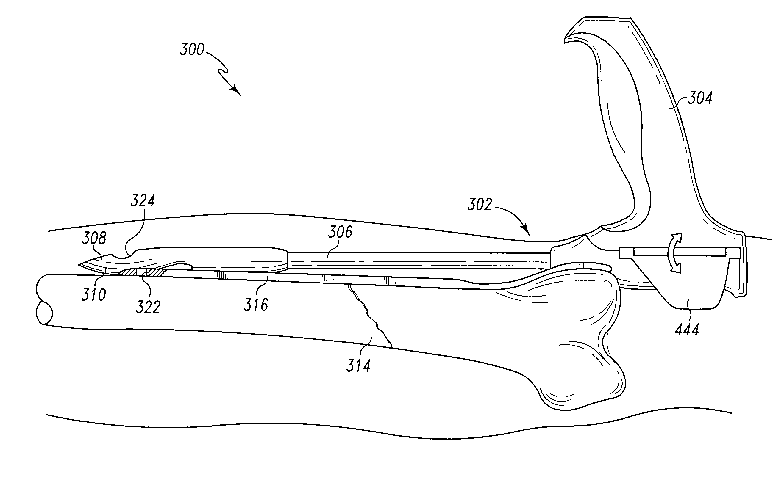 Minimally invasive orthopaedic apparatus and methods