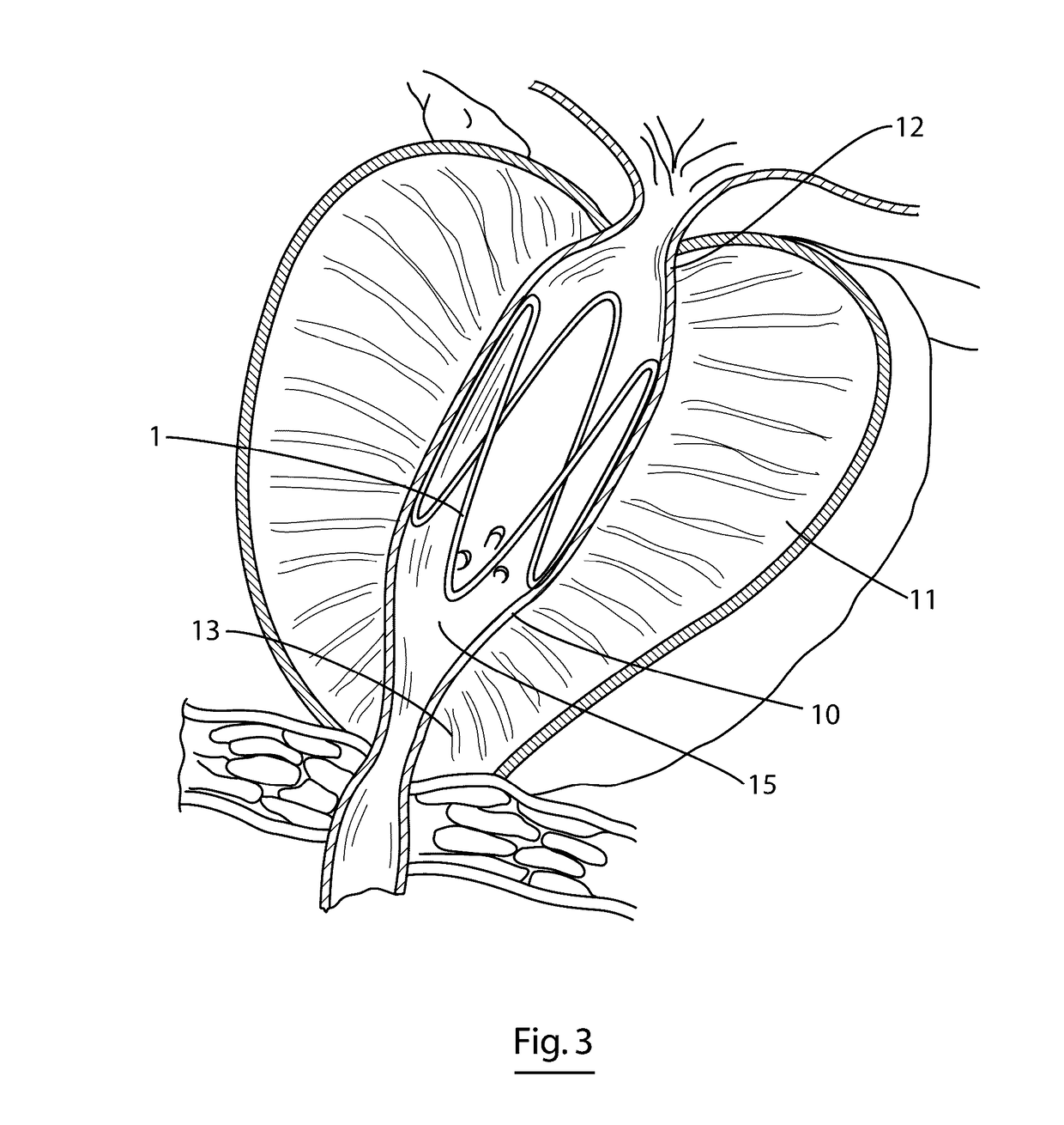 Implantable biocompatible expander suitable for treatment of constrictions of body lumen