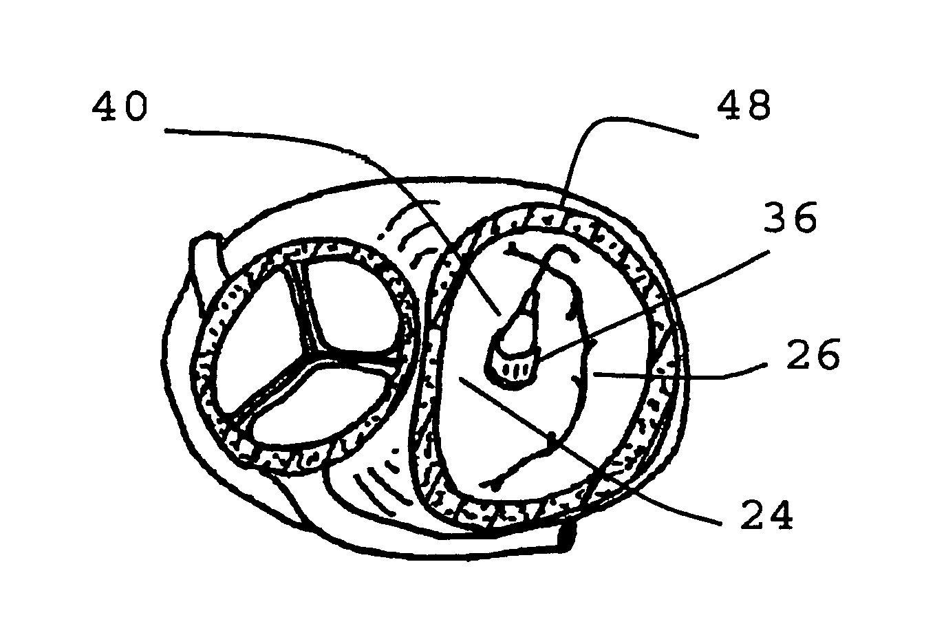 Method for implanting prosthetic valve