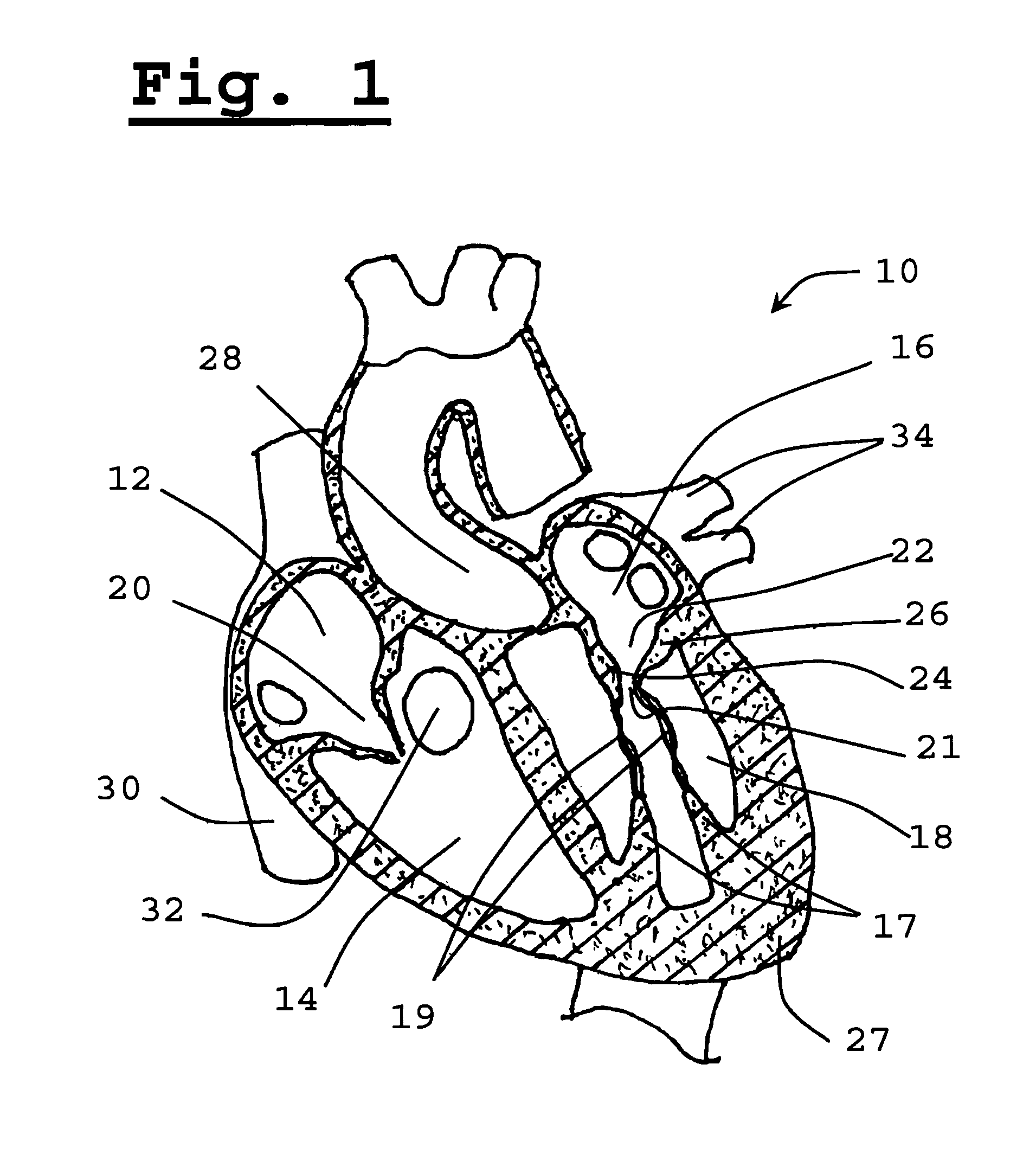 Method for implanting prosthetic valve