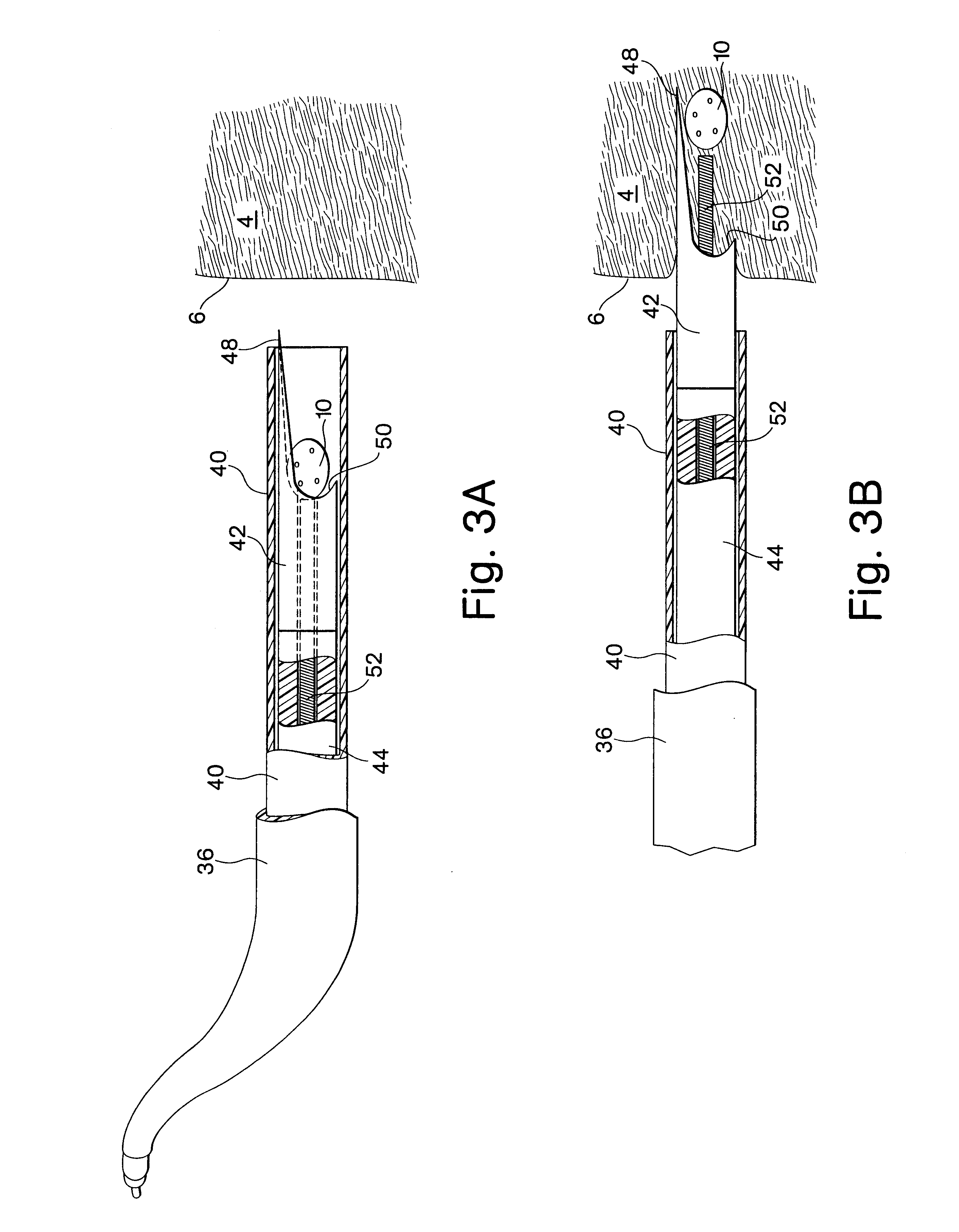 Flexible vascular inducing implants and methods