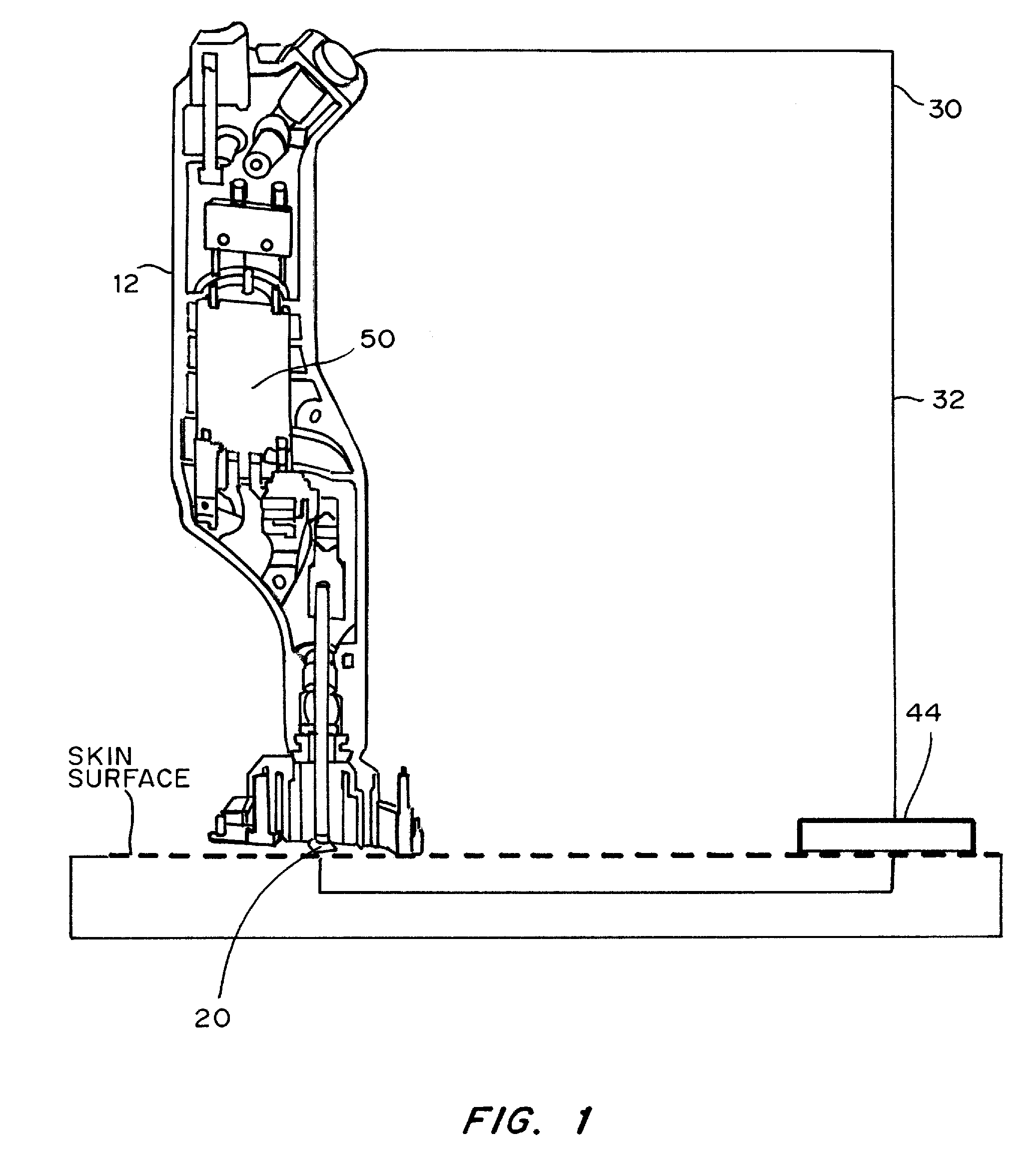 Skin permeation device for analyte sensing or transdermal drug delivery