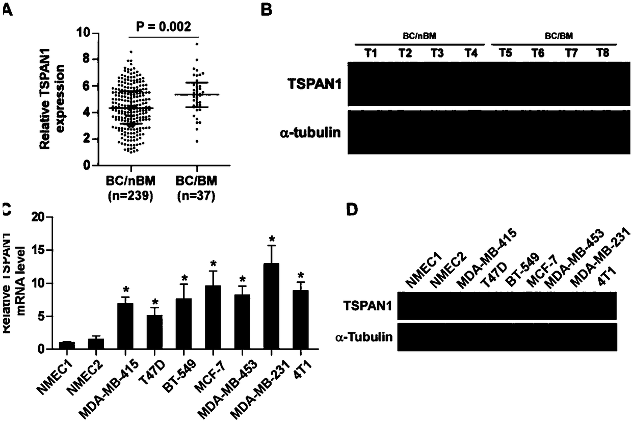 Application of TSPAN1 in diagnosis, prognosis and treatment of breast cancer metastasis