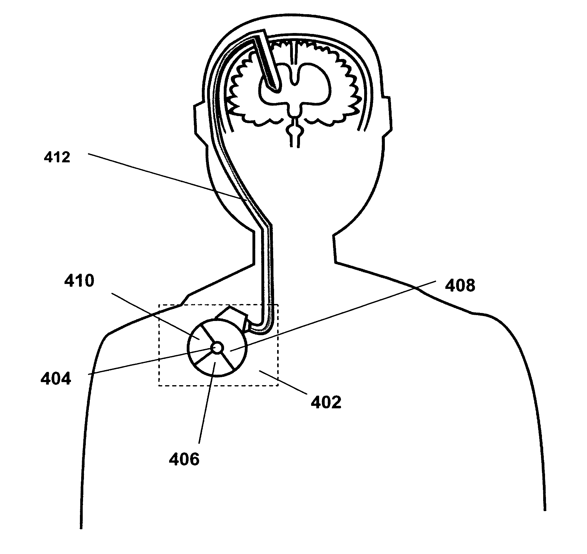 Method and apparatus for removing harmful proteins from a mammalian's ventricular cerebrospinal fluid