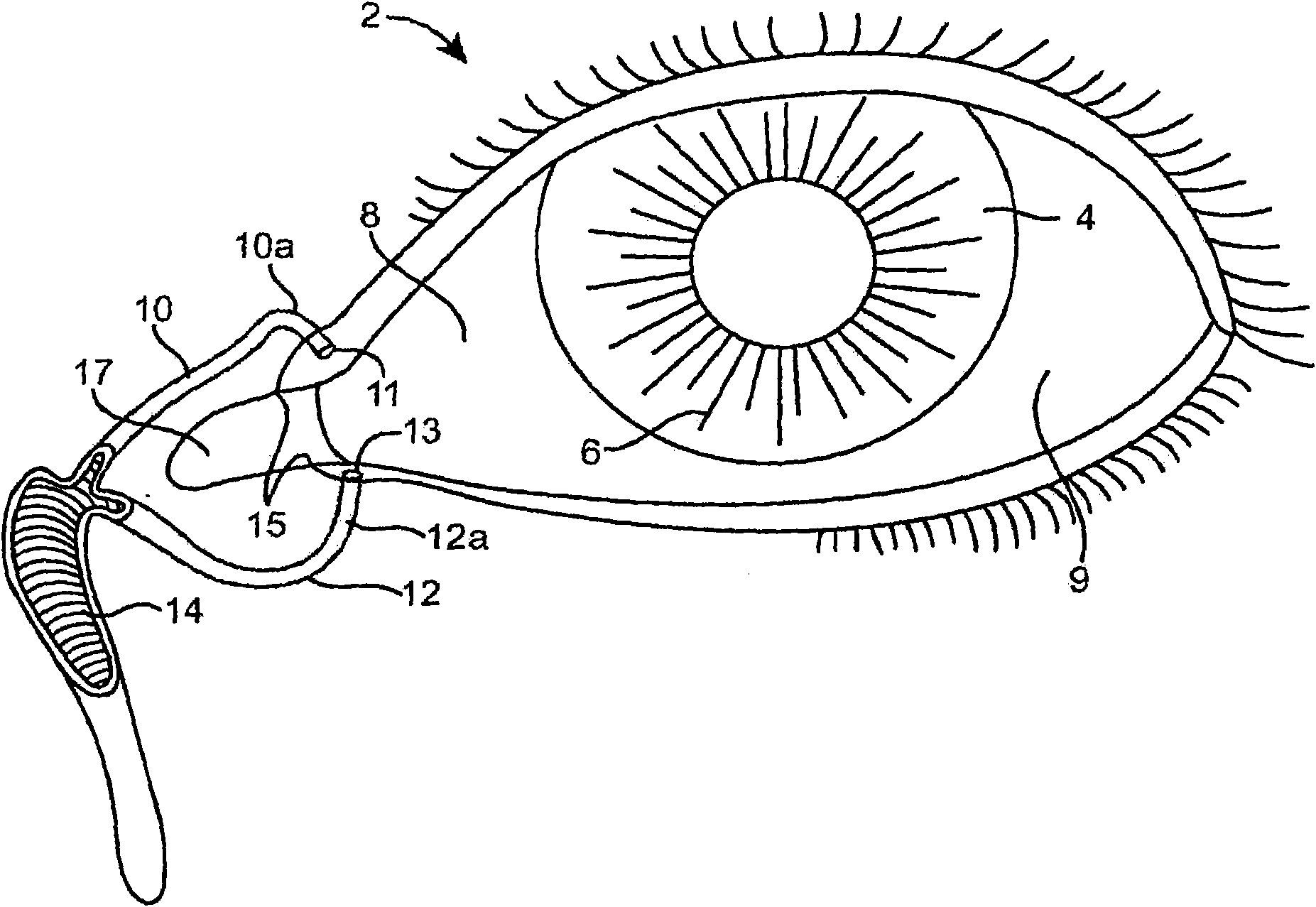 Drug delivery implants for inhibition of optical defects