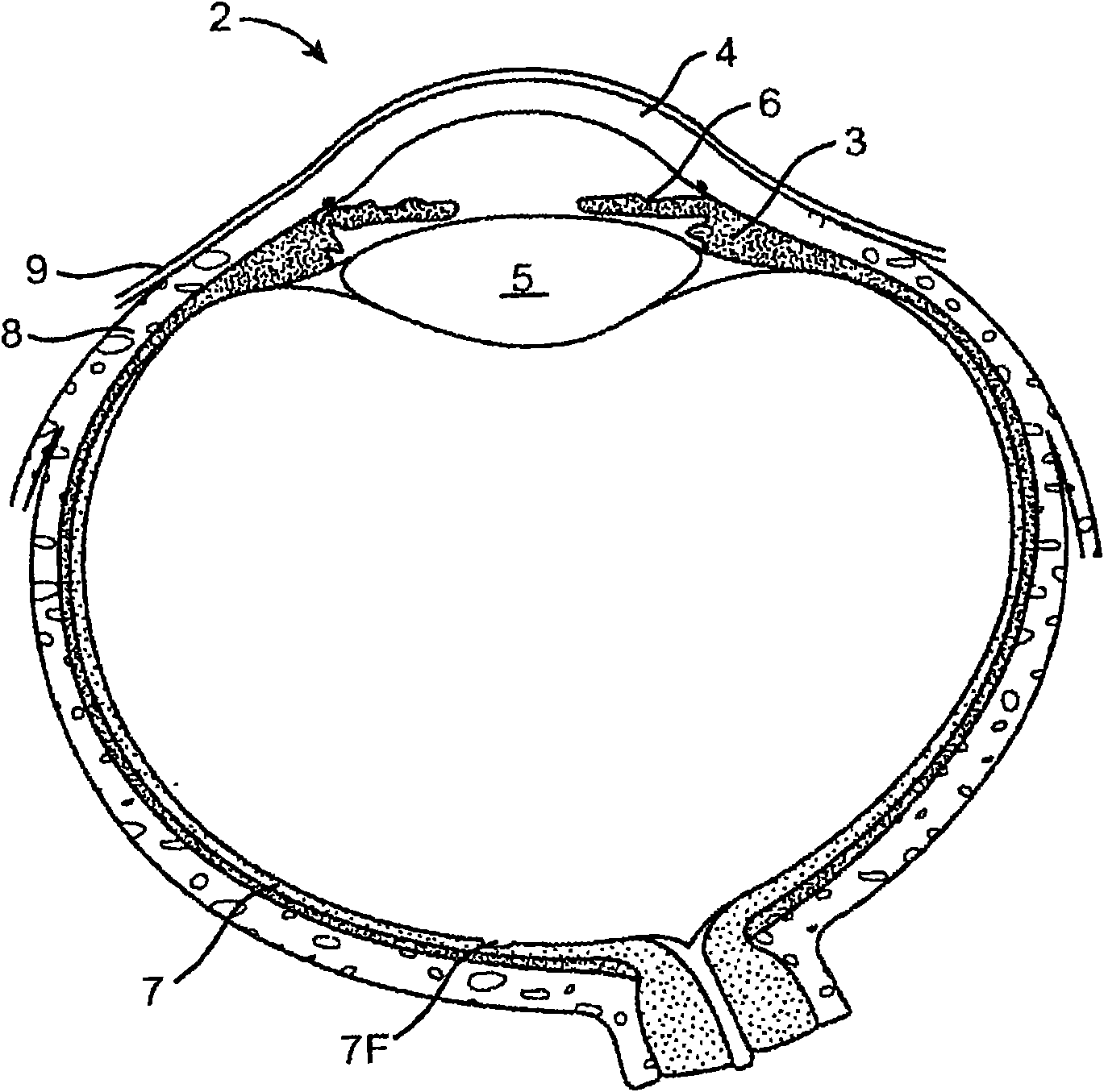 Drug delivery implants for inhibition of optical defects