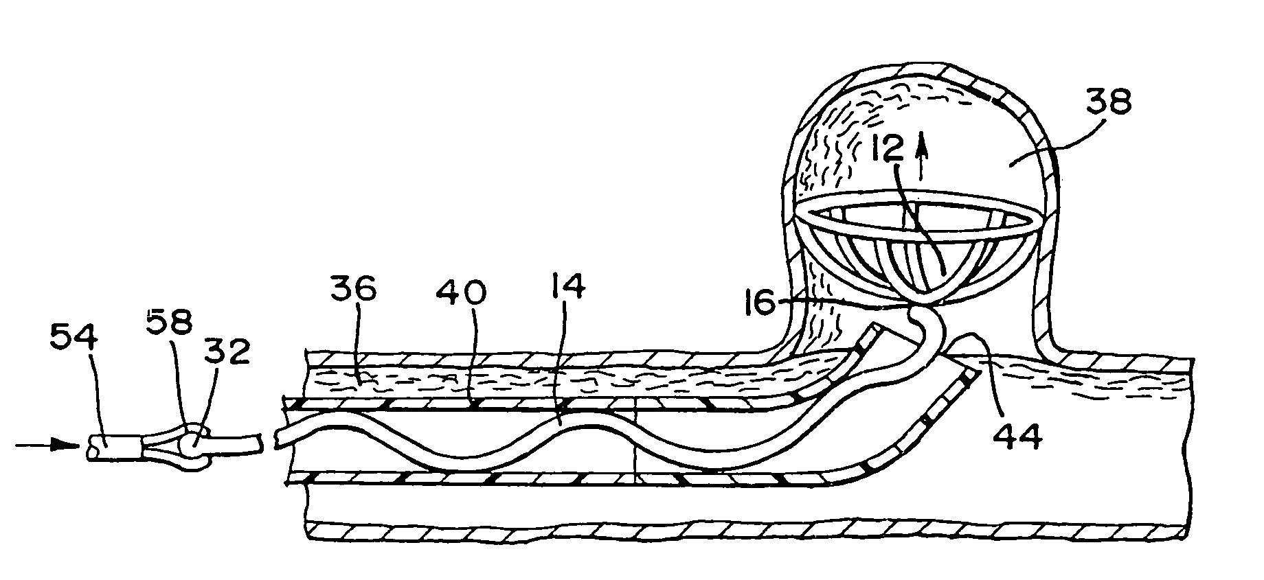 Stent embolization device