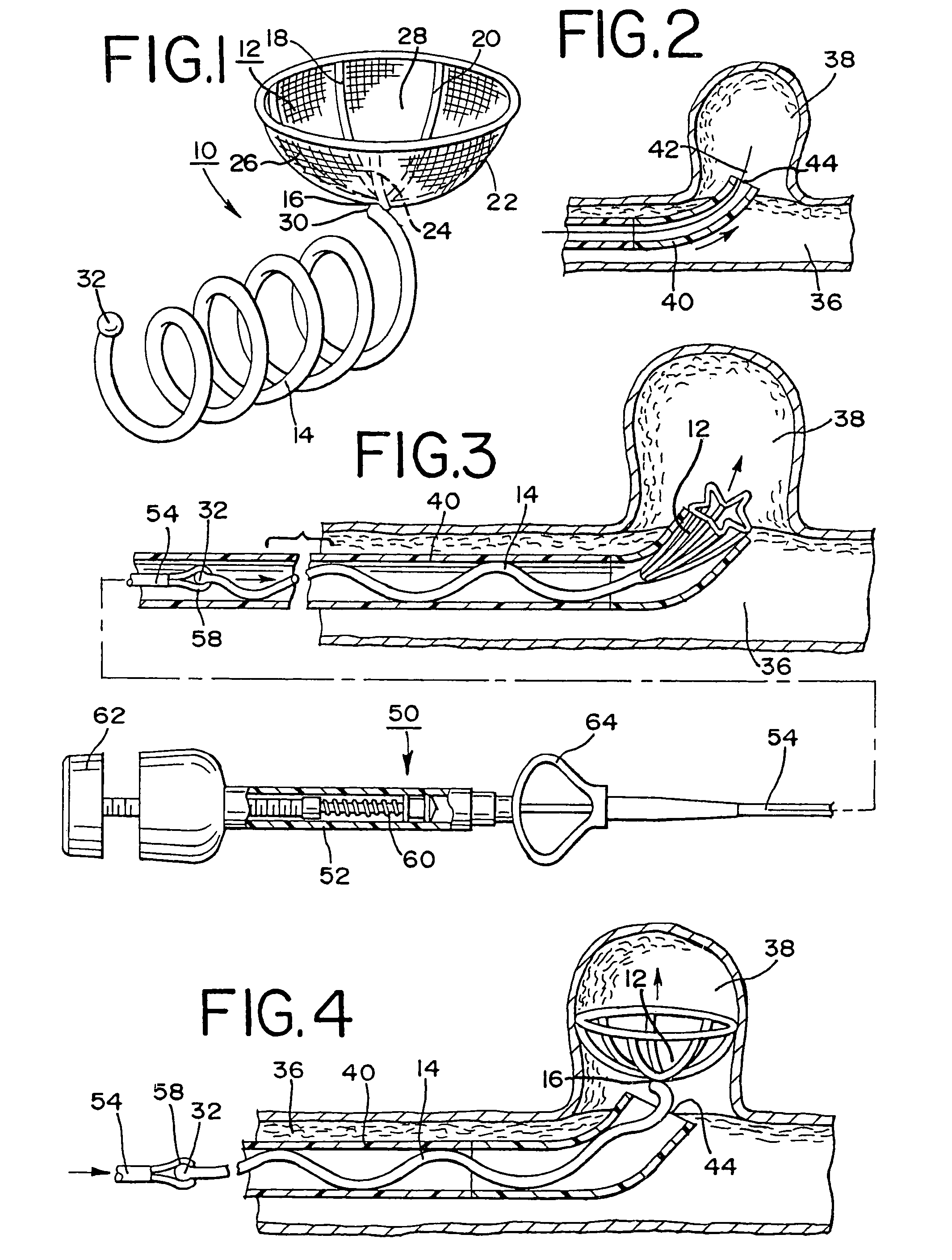 Stent embolization device