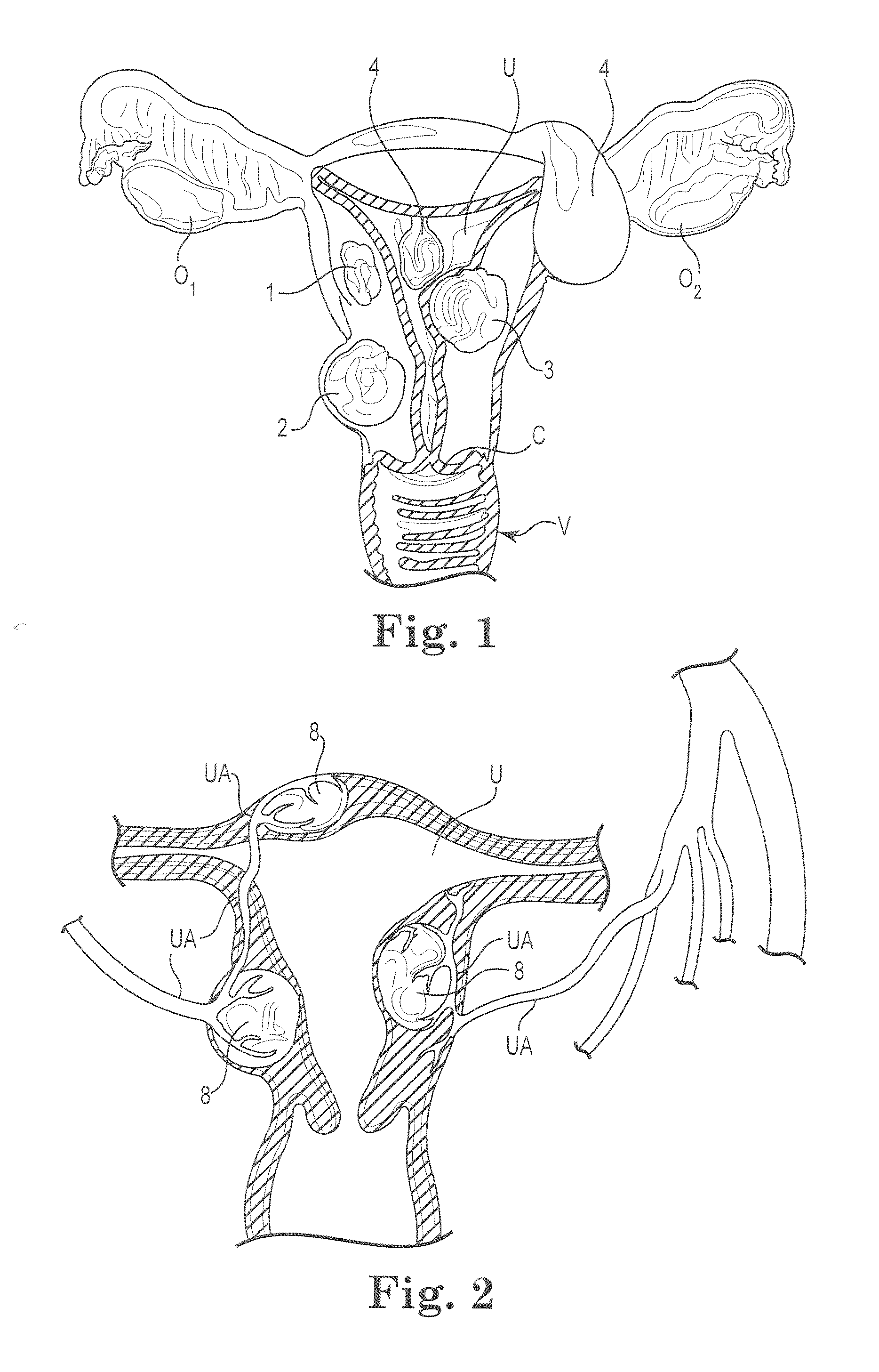 Fibroid Treatment System and Method