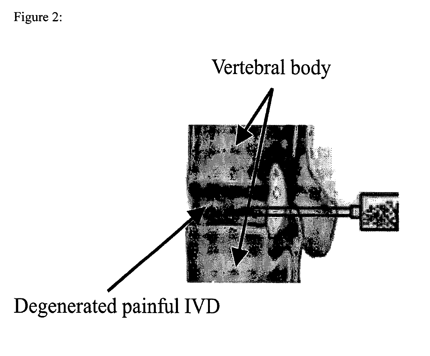 In situ controlled release drug delivery system