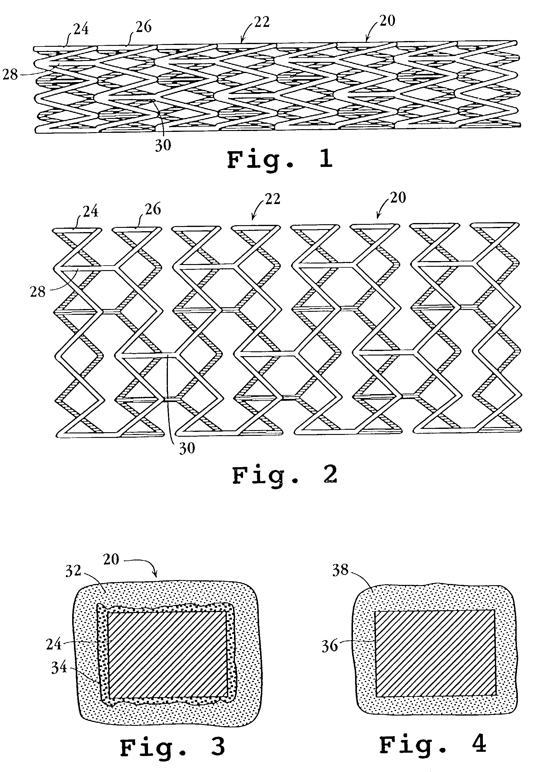 Drug-delivery endovascular stent and method for treating restenosis