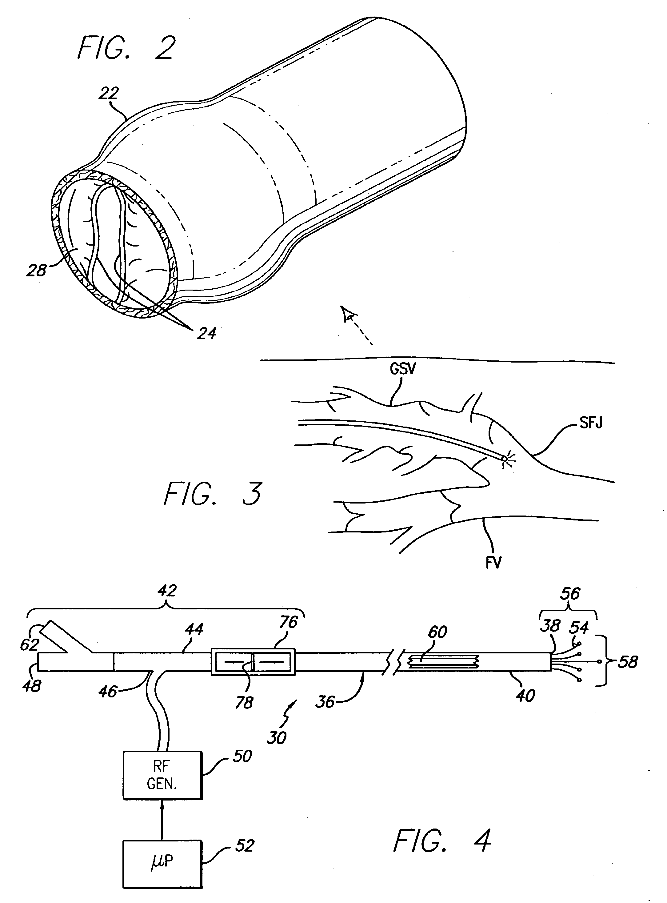 Method and apparatus for positioning a catheter relative to an anatomical junction