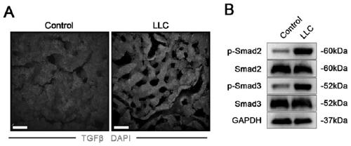 Application of TGF signal inhibitor in preventing and treating cancerous anemia