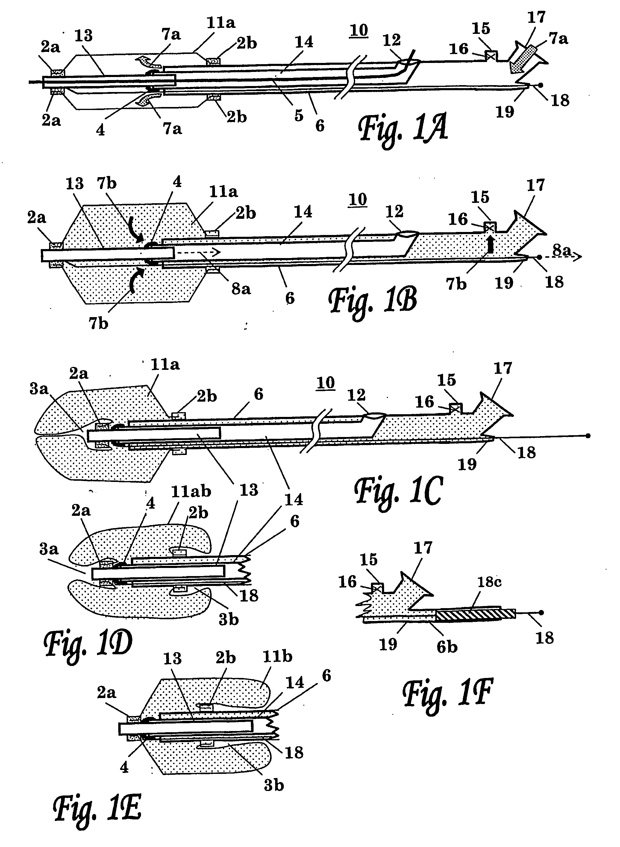 Balloon Catheter