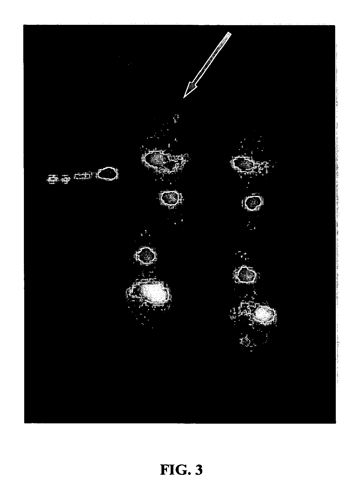 Oncolytic adenovirus armed with therapeutic genes