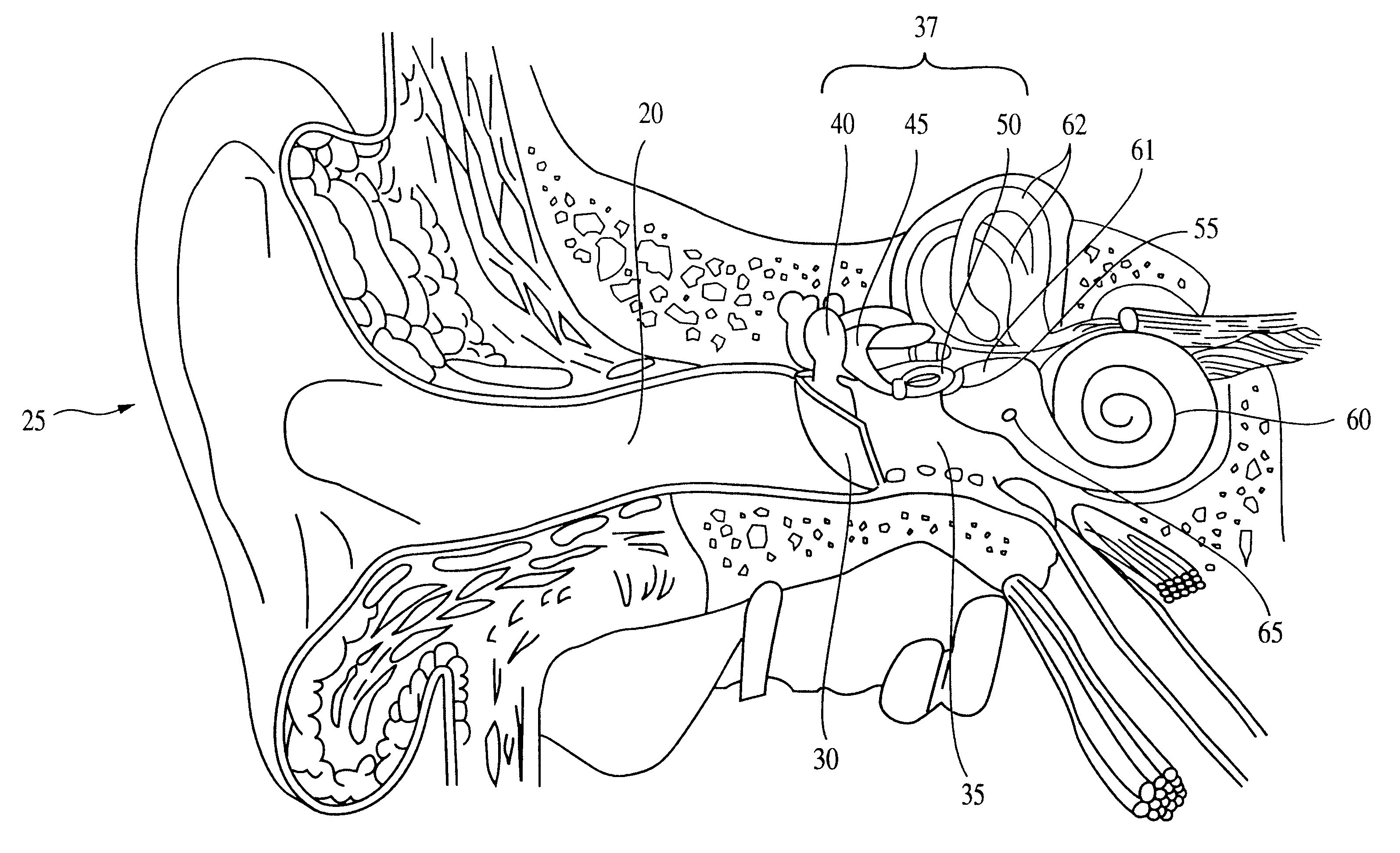 Method and apparatus for a programmable implantable hearing aid