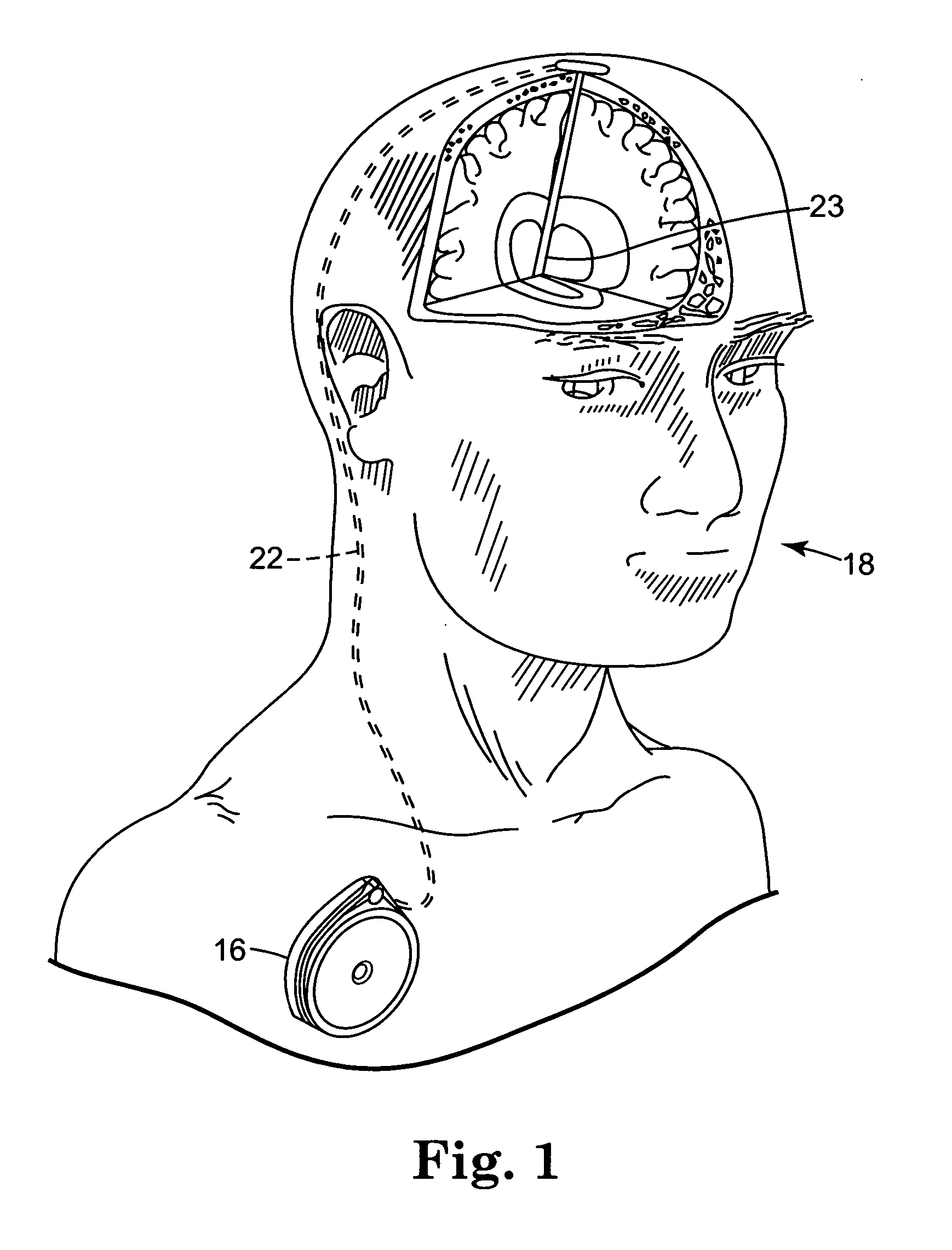 Actively cooled external energy source, external charger, system of transcutaneous energy transfer, system of transcutaneous charging and method therefore