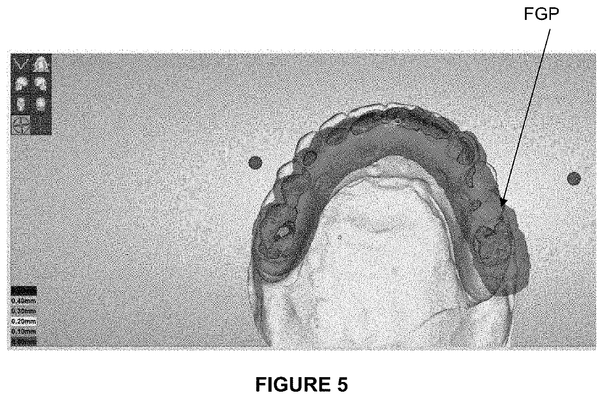 Method for determining a mapping of the contacts and/or distances between the maxillary and mandibular arches of a patient