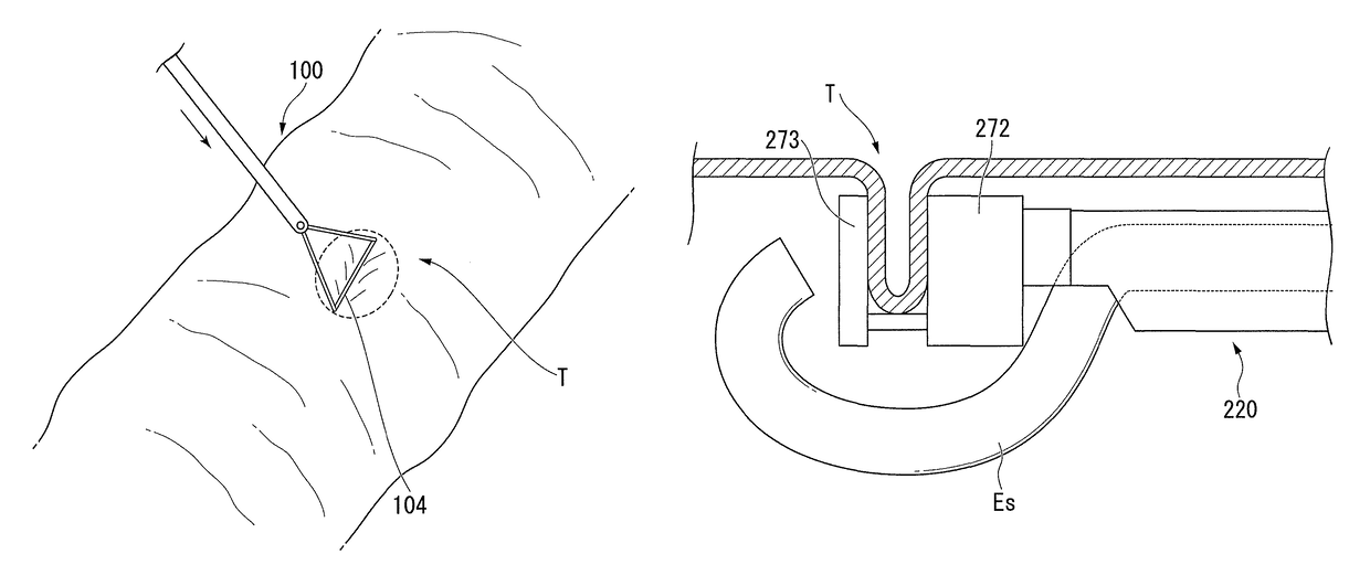 Method for tissue resection