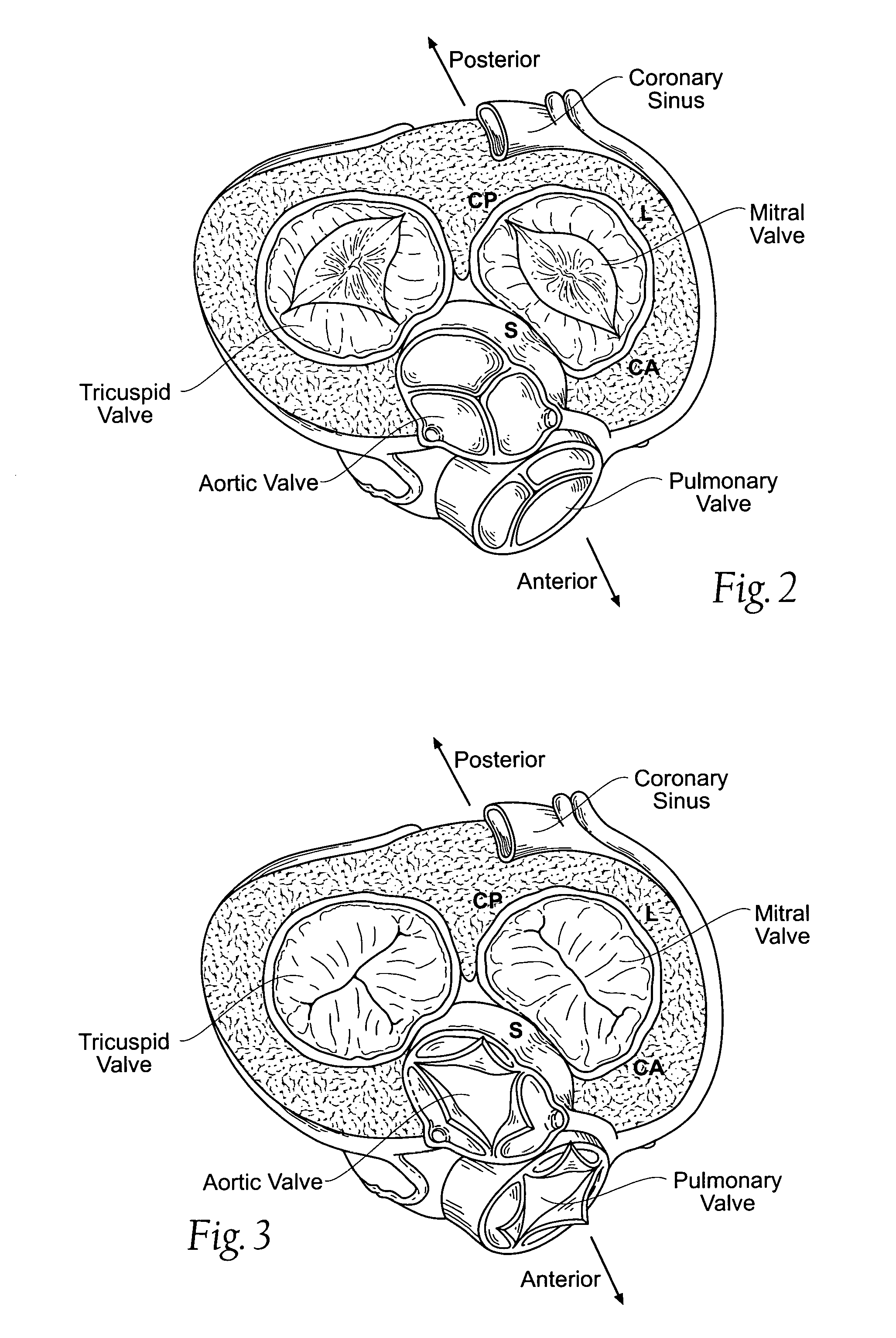 Devices, systems, and methods for reshaping a heart valve annulus