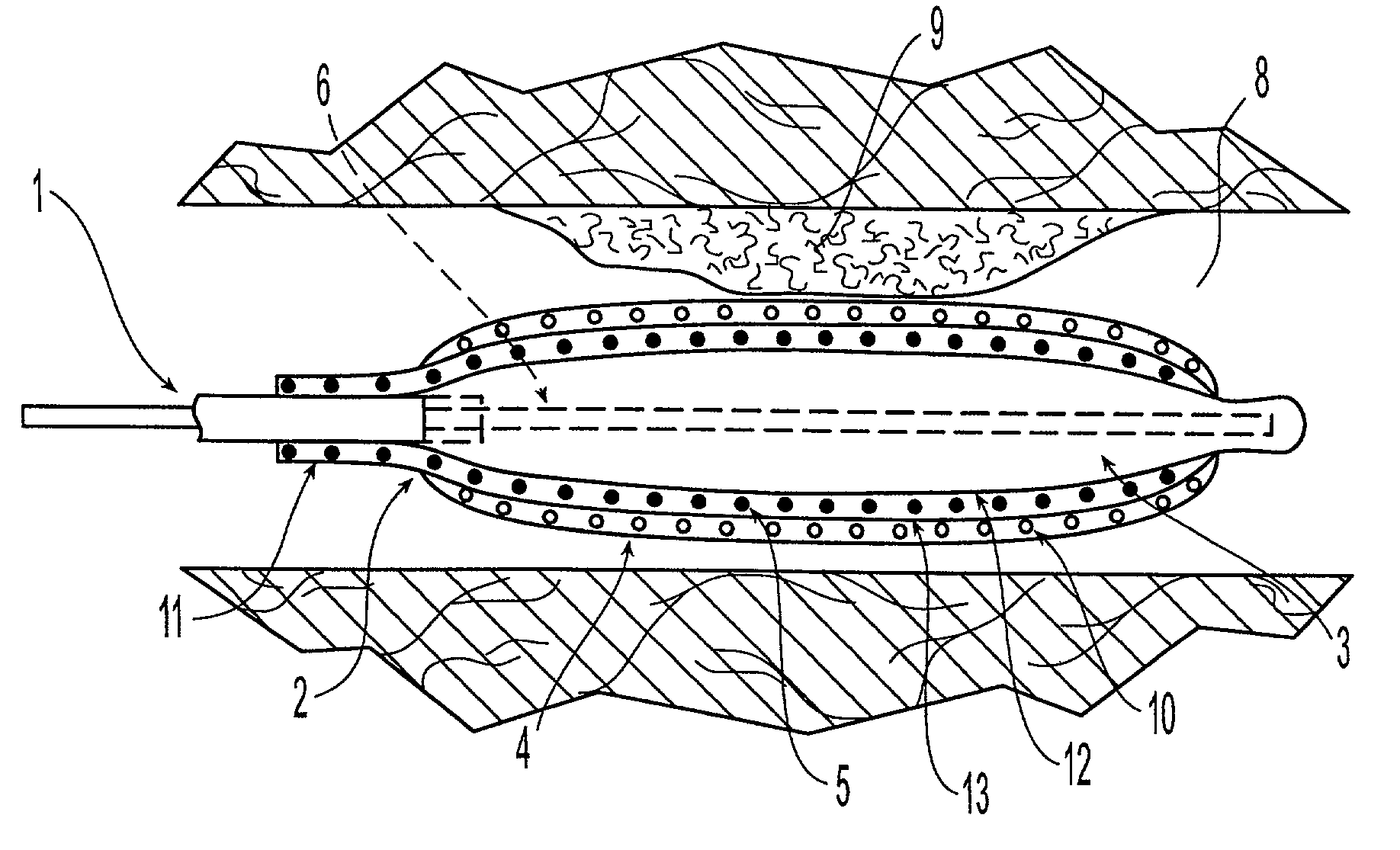 Medical device with sponge coating for controlled drug release