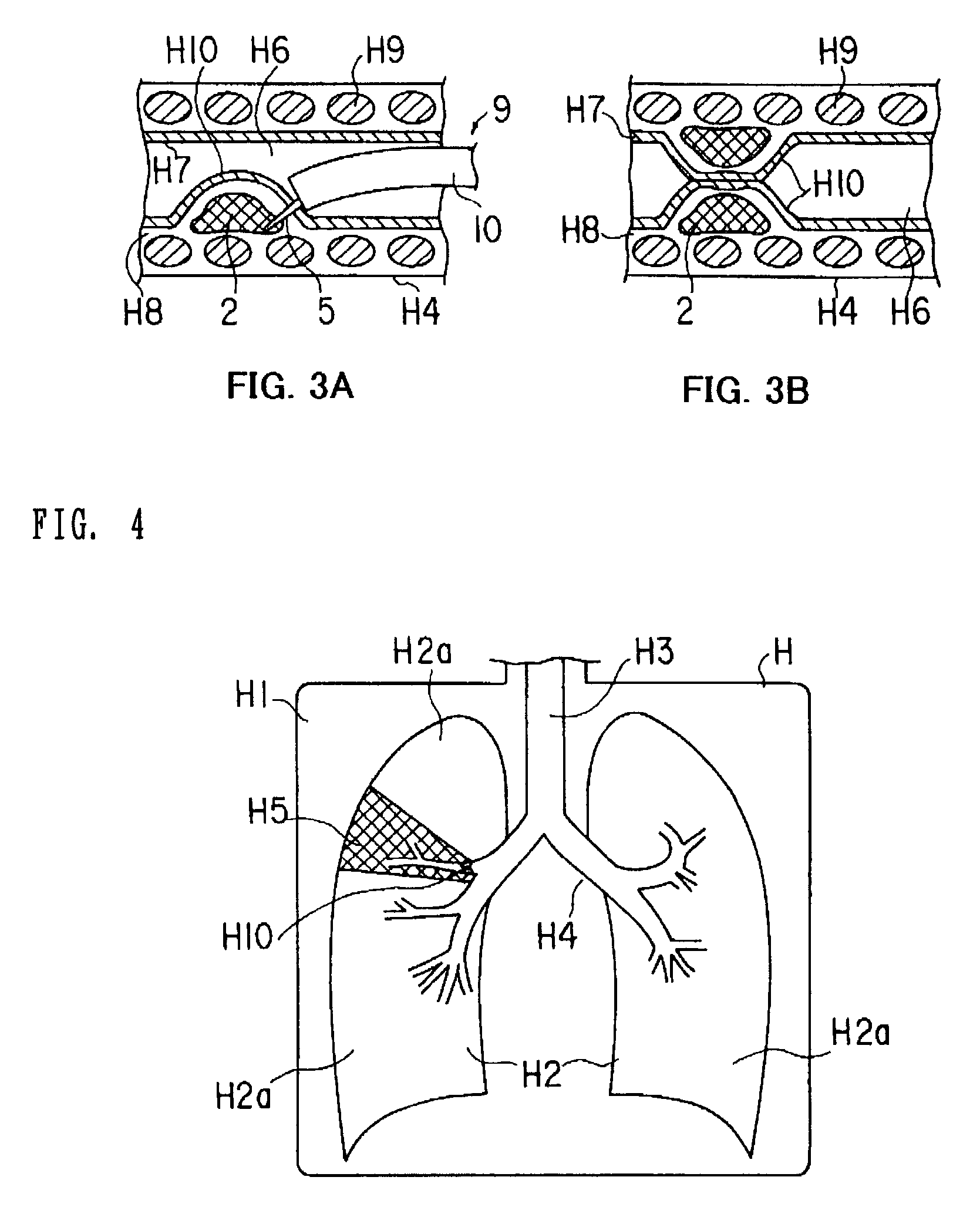 Medical device and method of embolizing bronchus or bronchiole