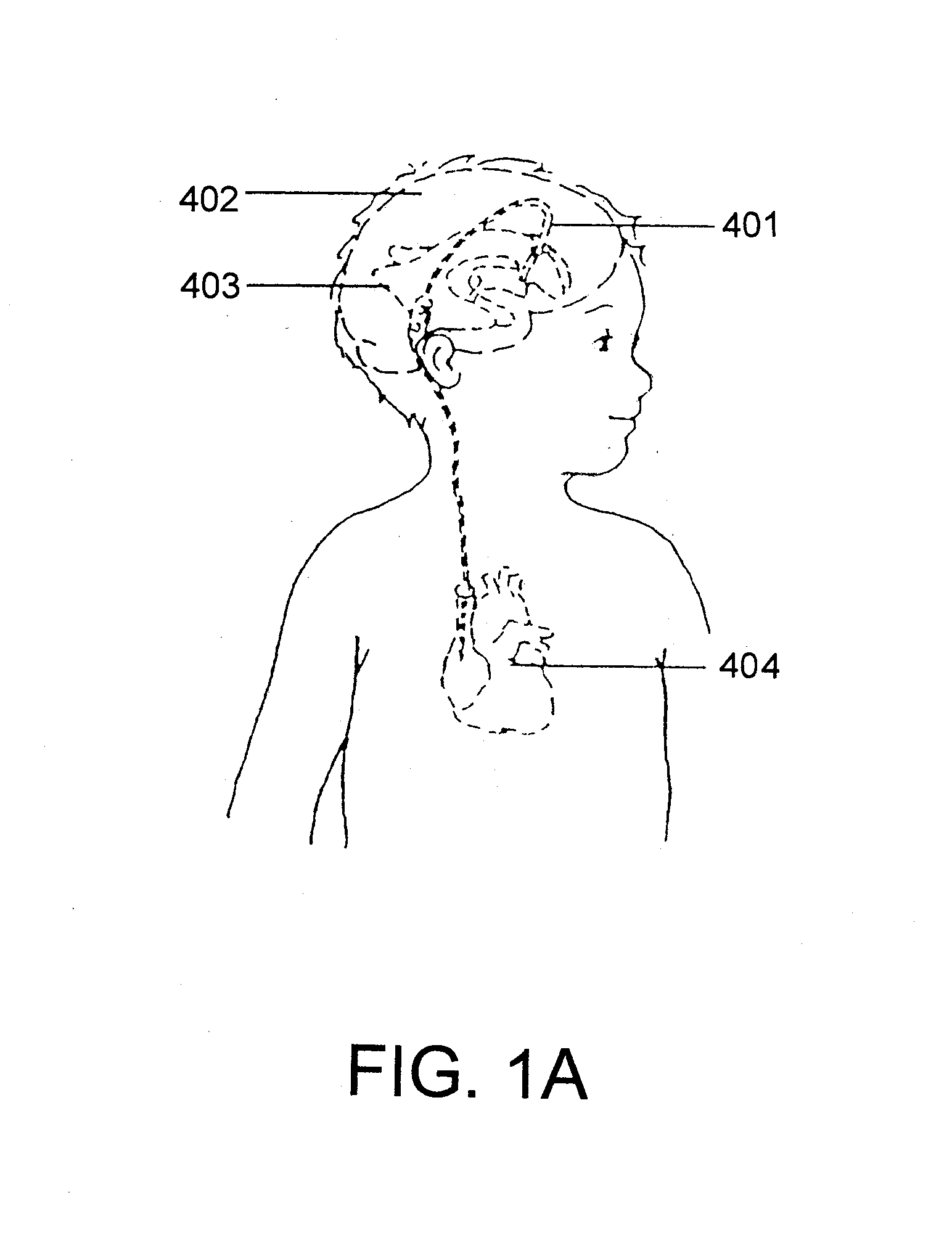 Adjustable hydrocephalus valve