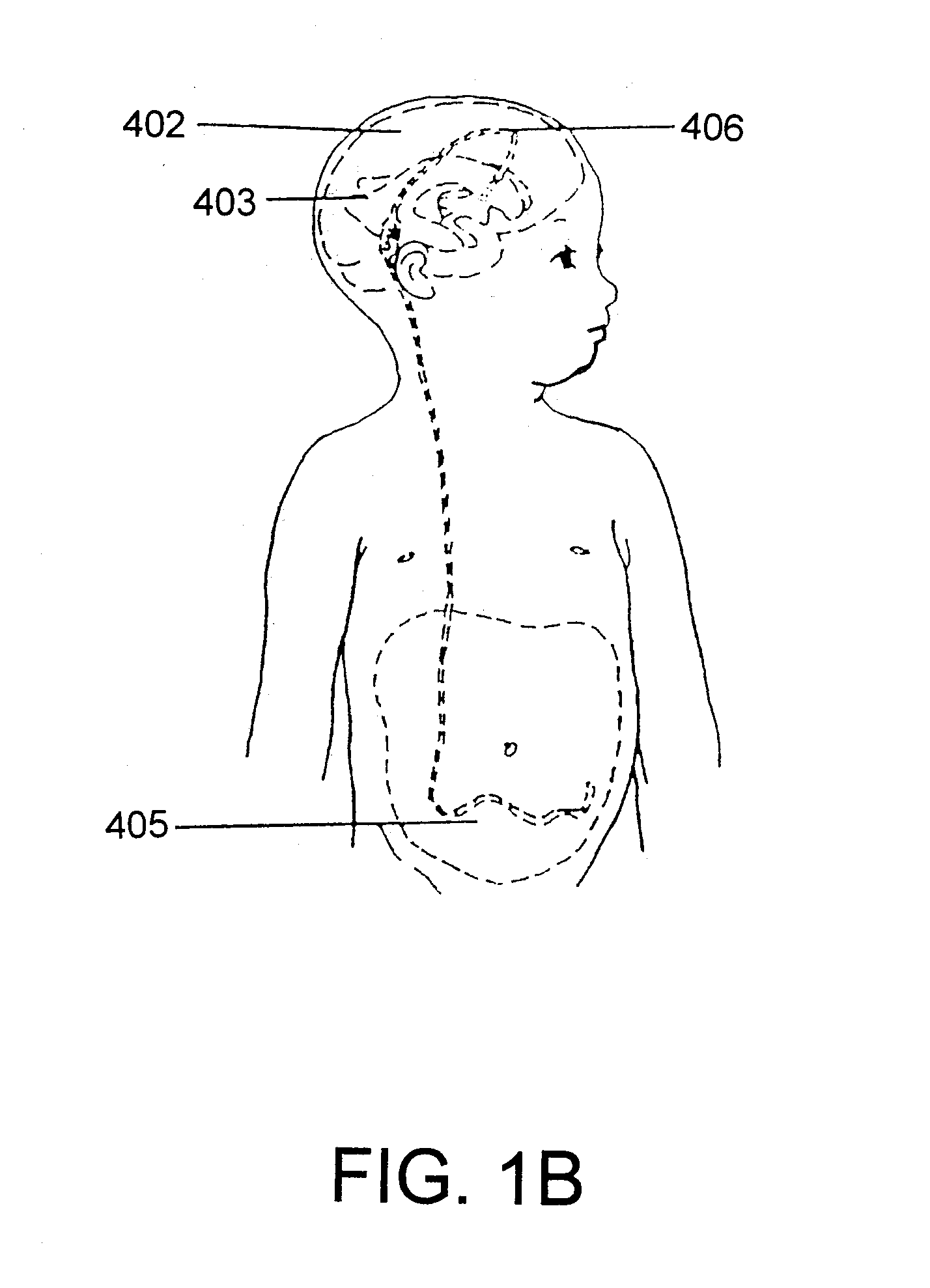 Adjustable hydrocephalus valve