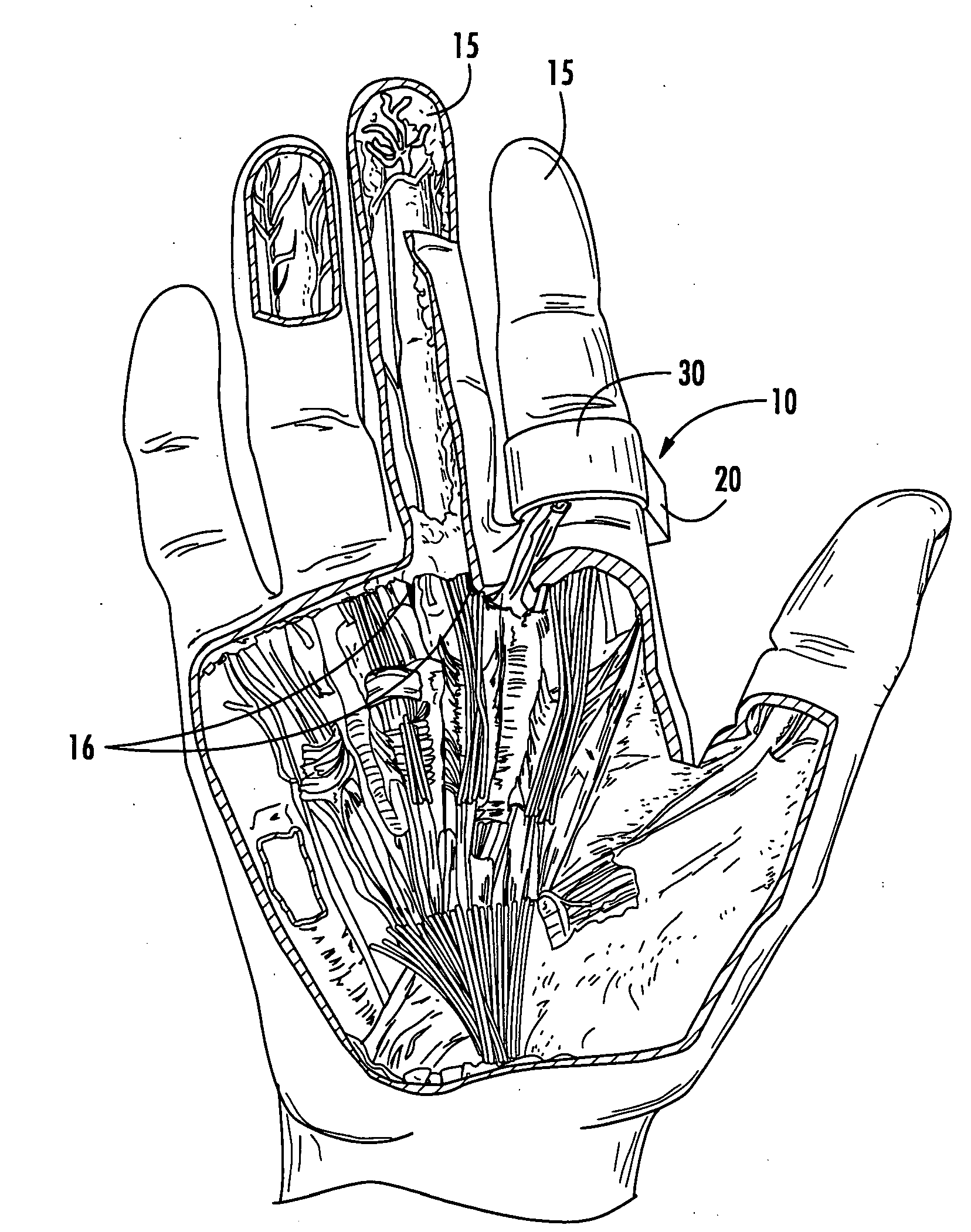 Disposable digital tourniquets and related methods of providing occlusion pressures to a single digit during surgical procedures