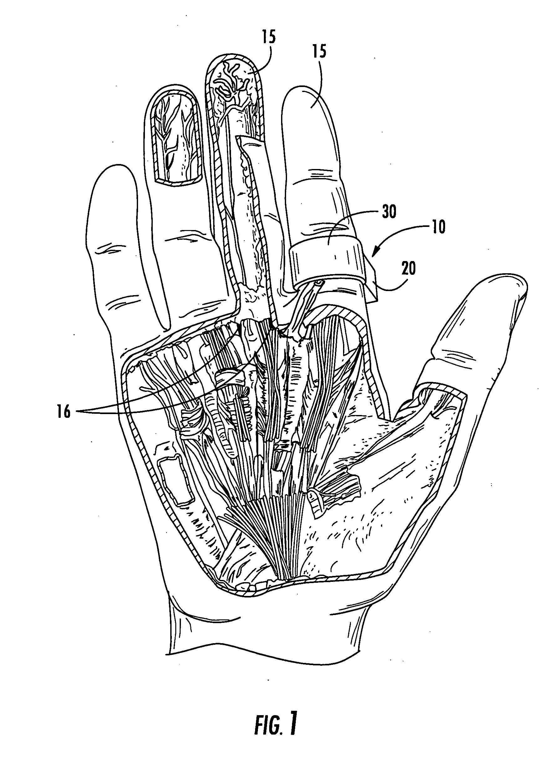 Disposable digital tourniquets and related methods of providing occlusion pressures to a single digit during surgical procedures