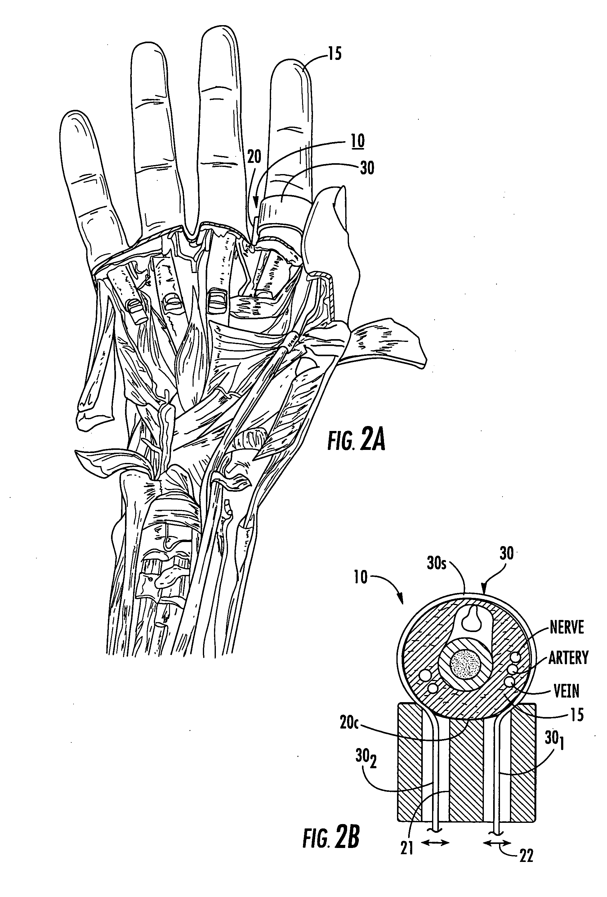 Disposable digital tourniquets and related methods of providing occlusion pressures to a single digit during surgical procedures