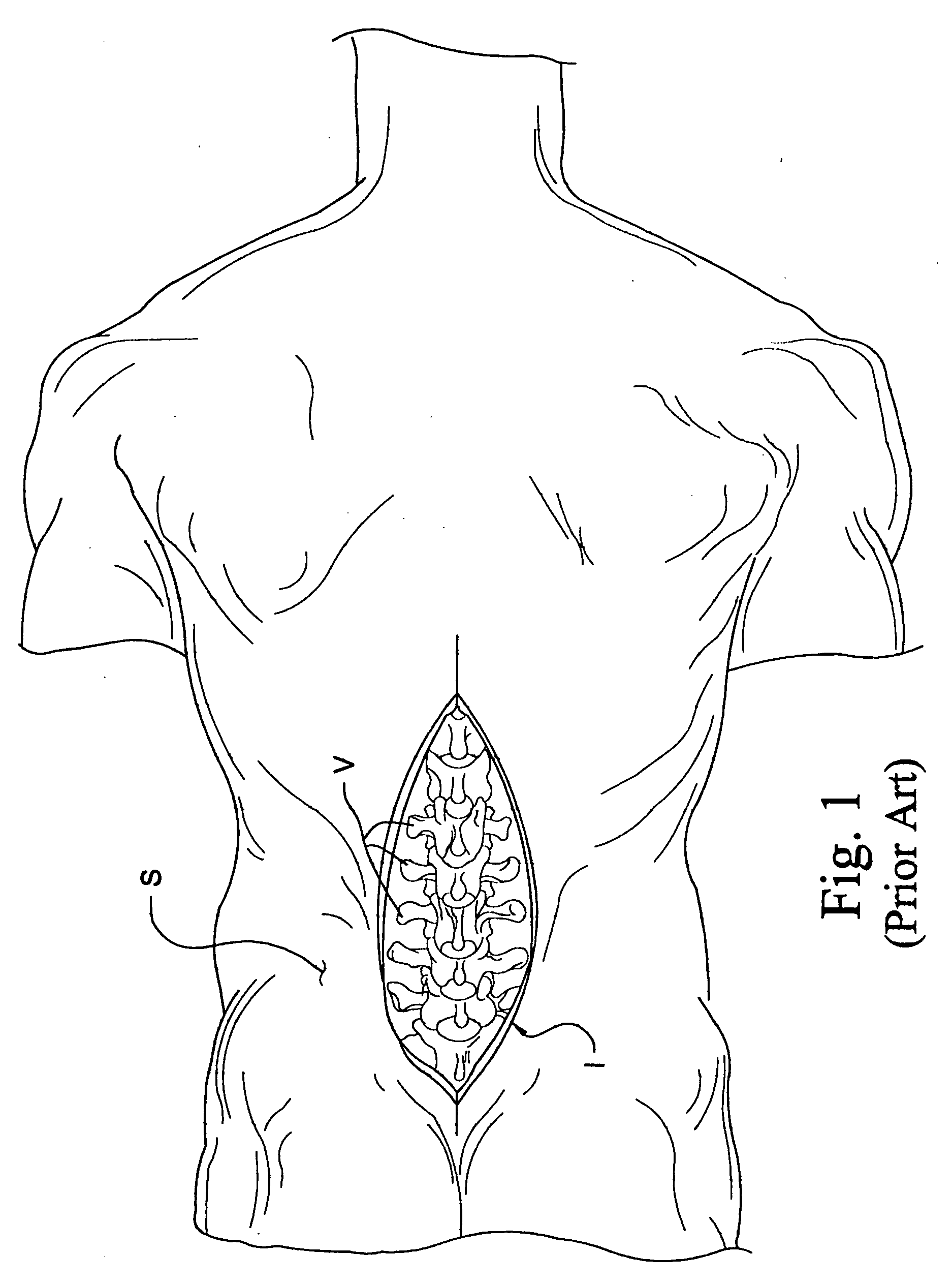 Instrumentation and method for mounting a surgical navigation reference device to a patient