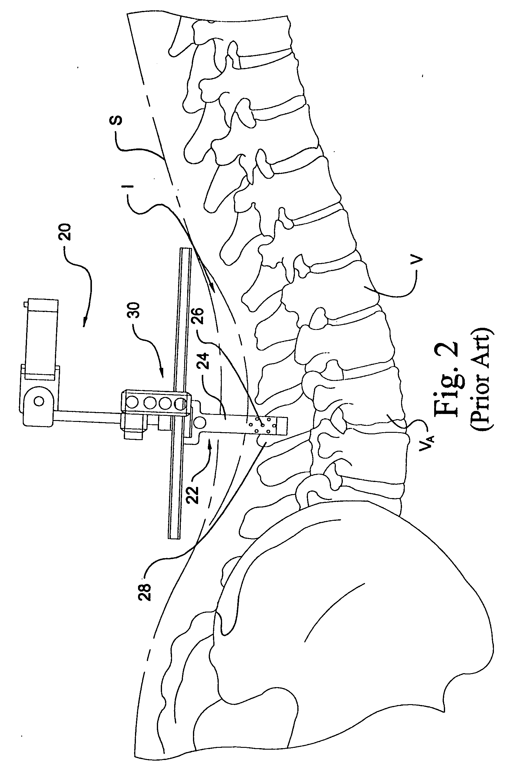 Instrumentation and method for mounting a surgical navigation reference device to a patient