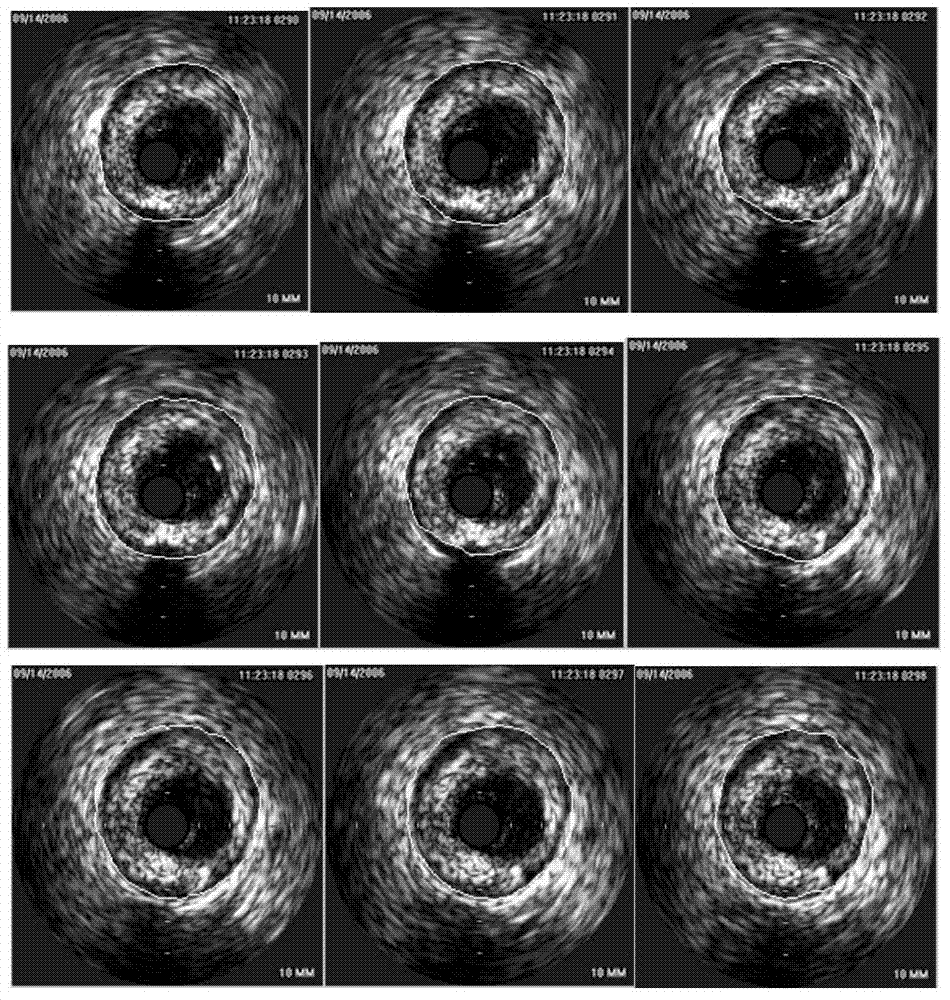 Blood vessel ROI dividing method based on intravascular ultrasonic image