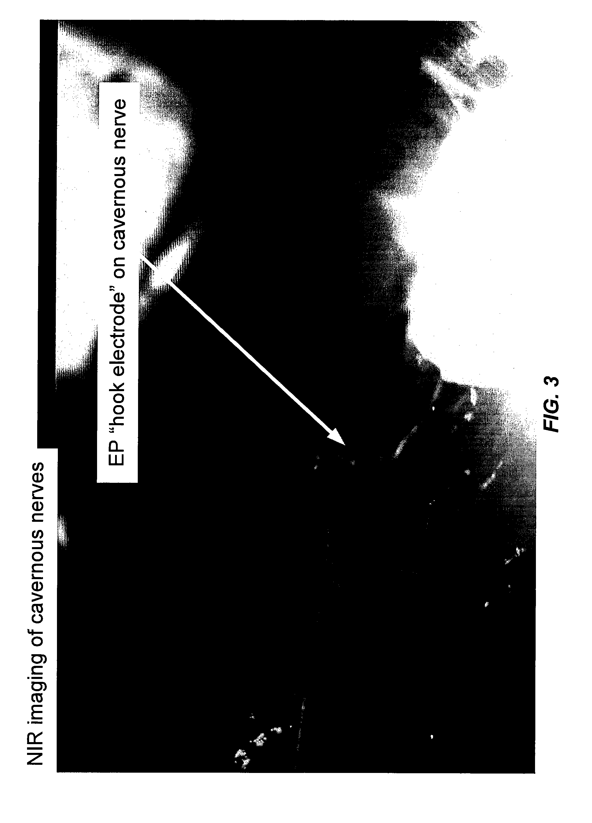 Intraoperative determination of nerve location