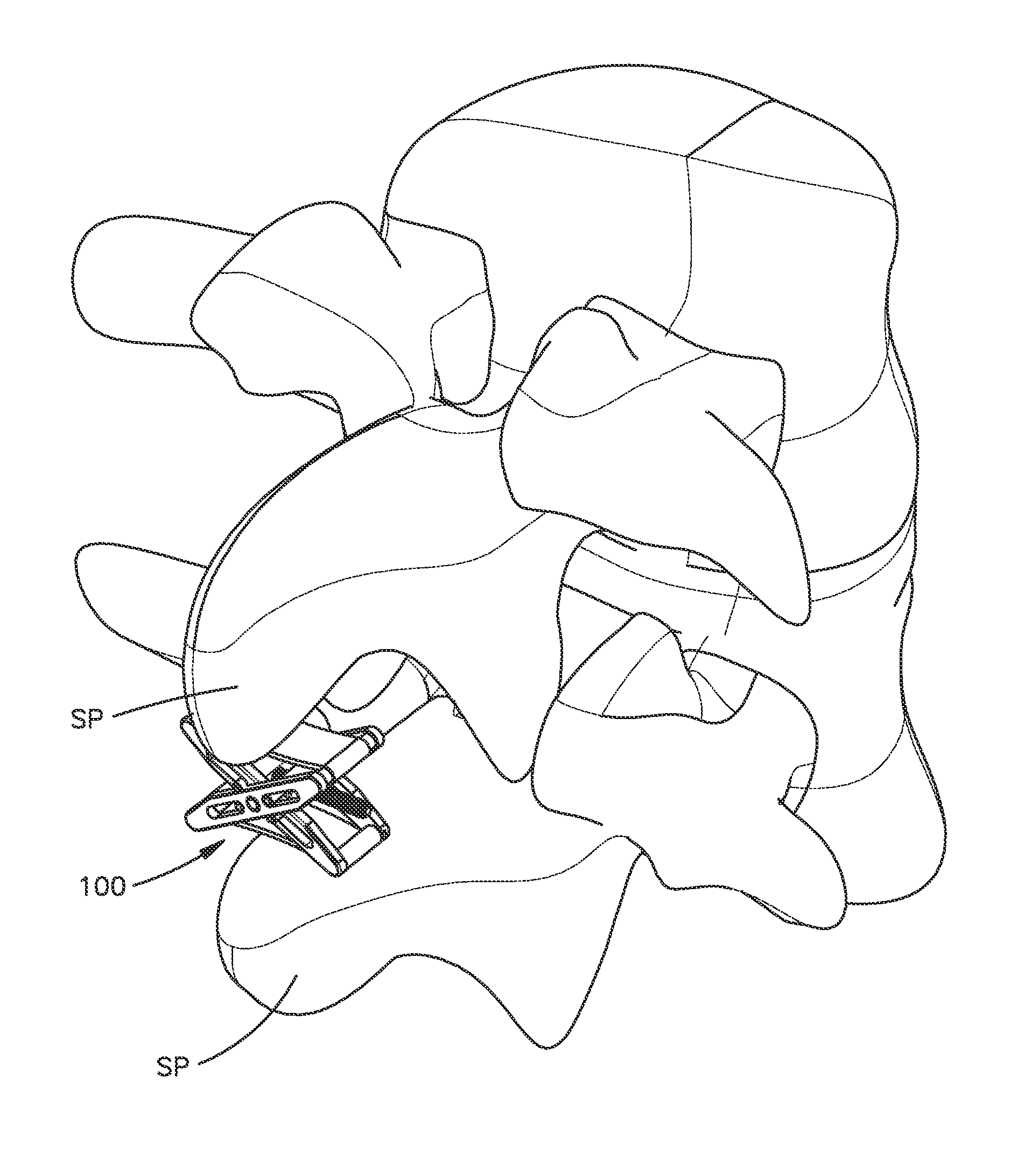 Expandable interspinous process spacer