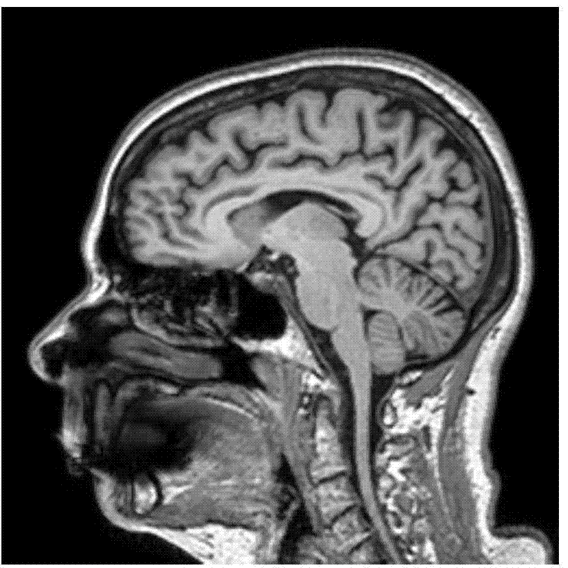 Medical image registration method based on cross hill-climbing memetic quantum evolutionary computation