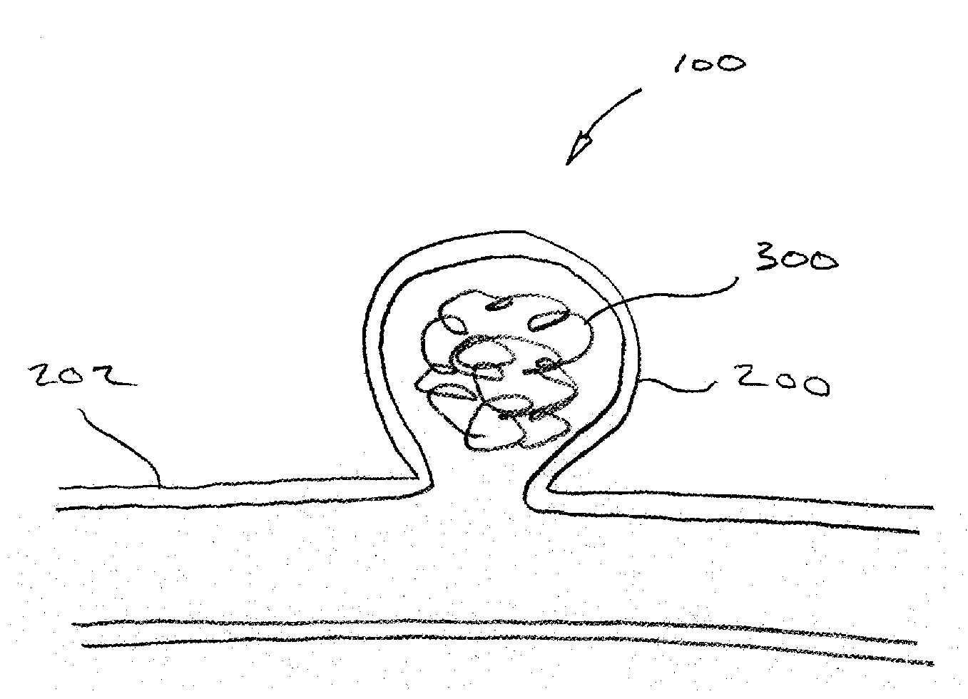 Implant for aneurysm treatment