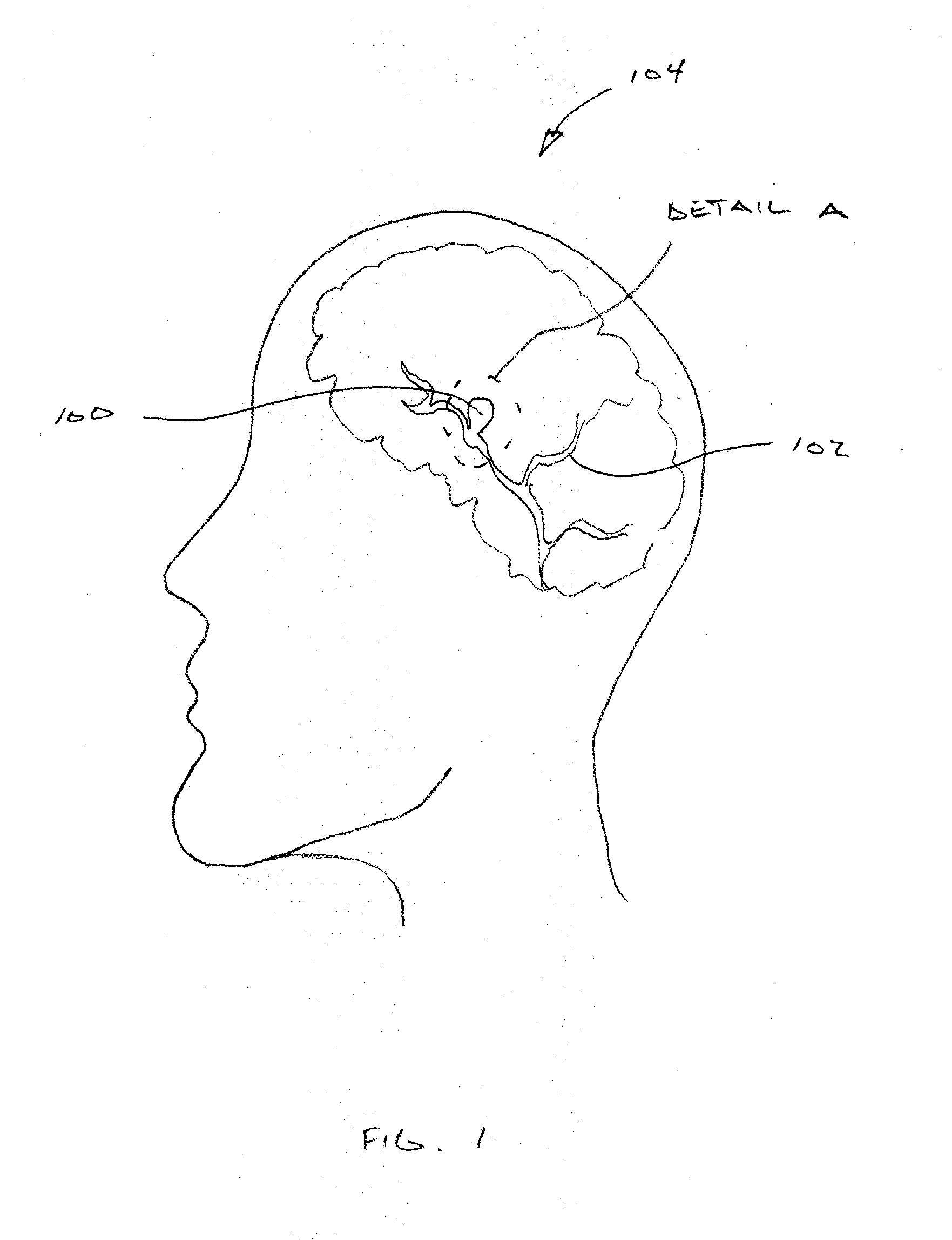 Implant for aneurysm treatment